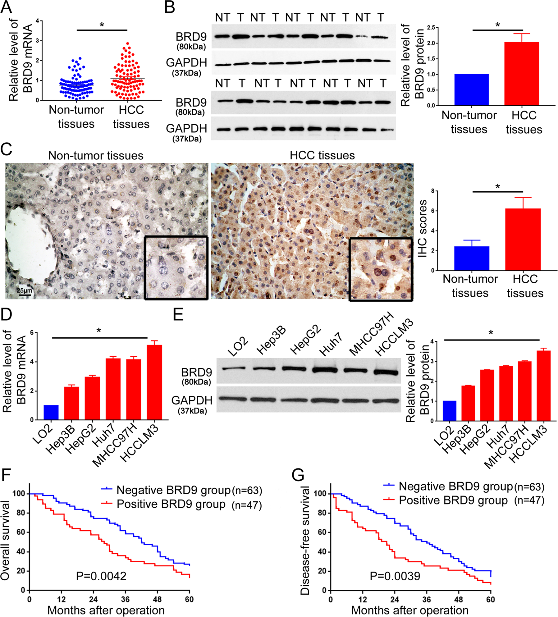 Fig. 1: The expression and prognostic significance of BRD9 in HCC.