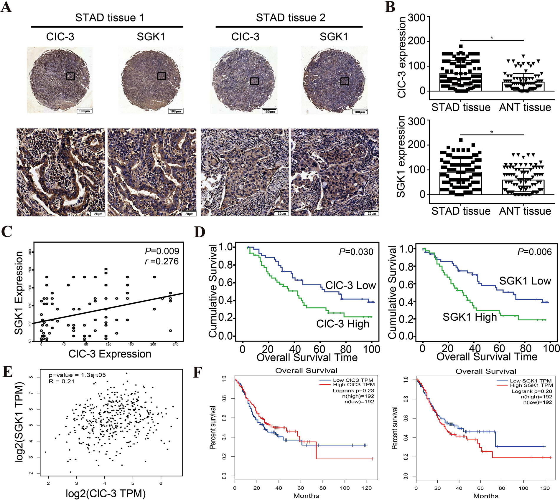Fig. 7: ClC-3 and SGK1 were positively correlated and highly expressed in human STAD tissues.
