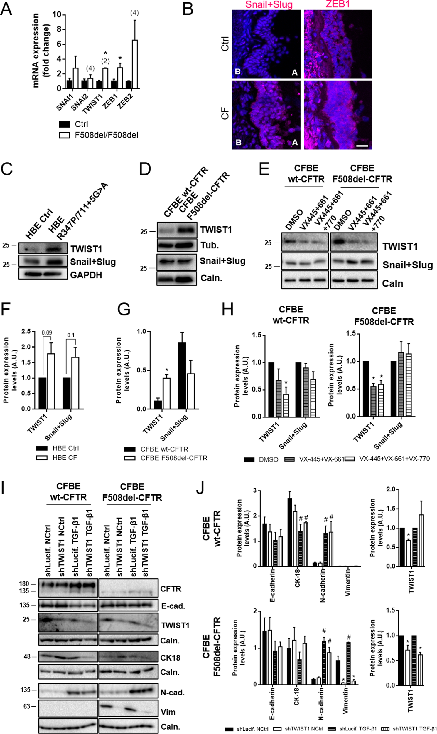 Fig. 6: EMT-inducing transcription factors (EMT-TFs) are increased in the absence of functional CFTR, with TWIST1 mediating mutant CFTR driven EMT.