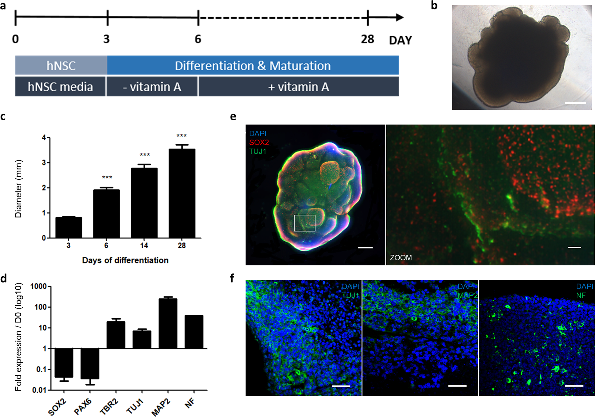 Morphology of Niemann-Pick type A metabolic storage disorder