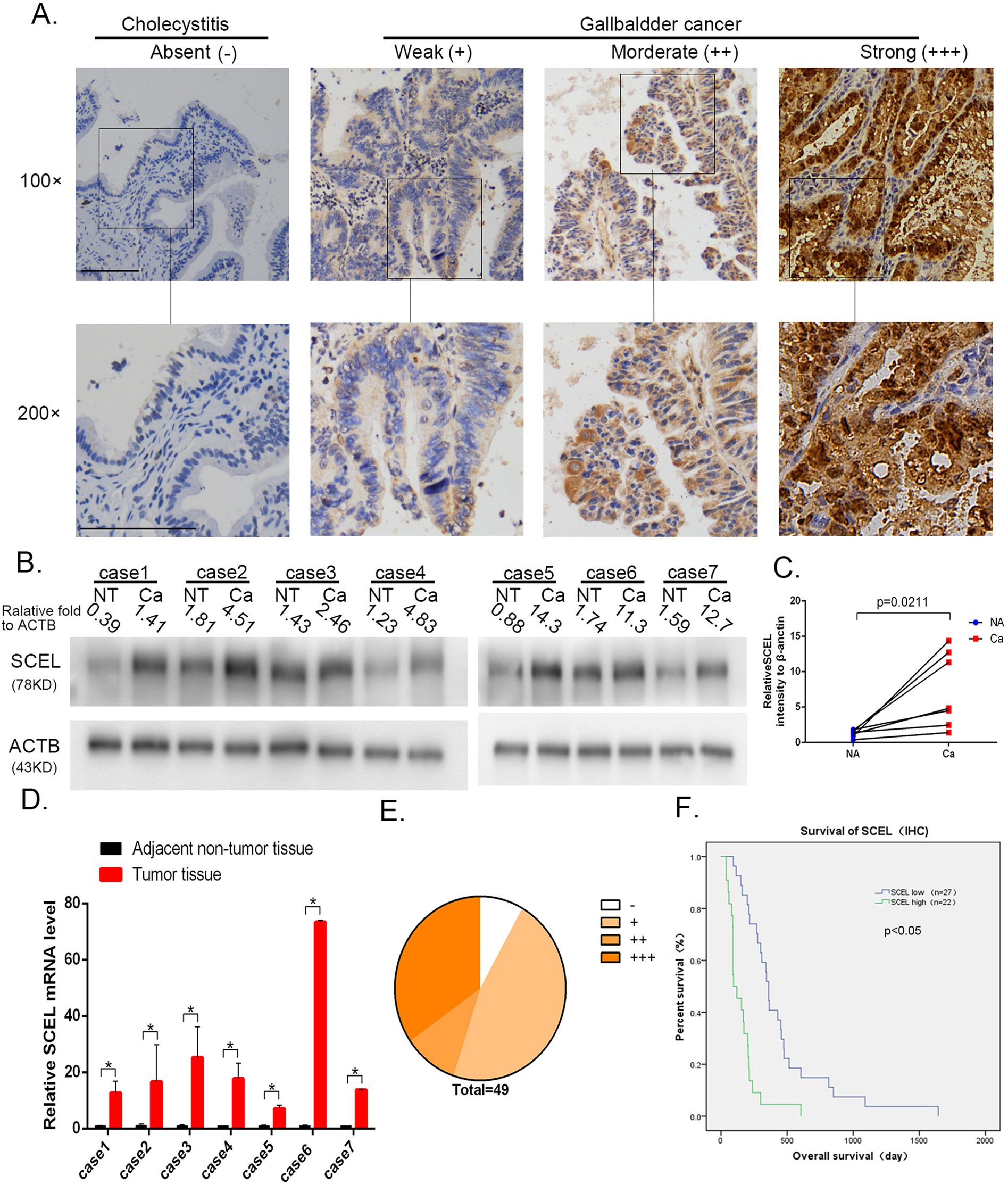 Fig. 1: The expression and clinical significance of SCEL in GBC tissues.