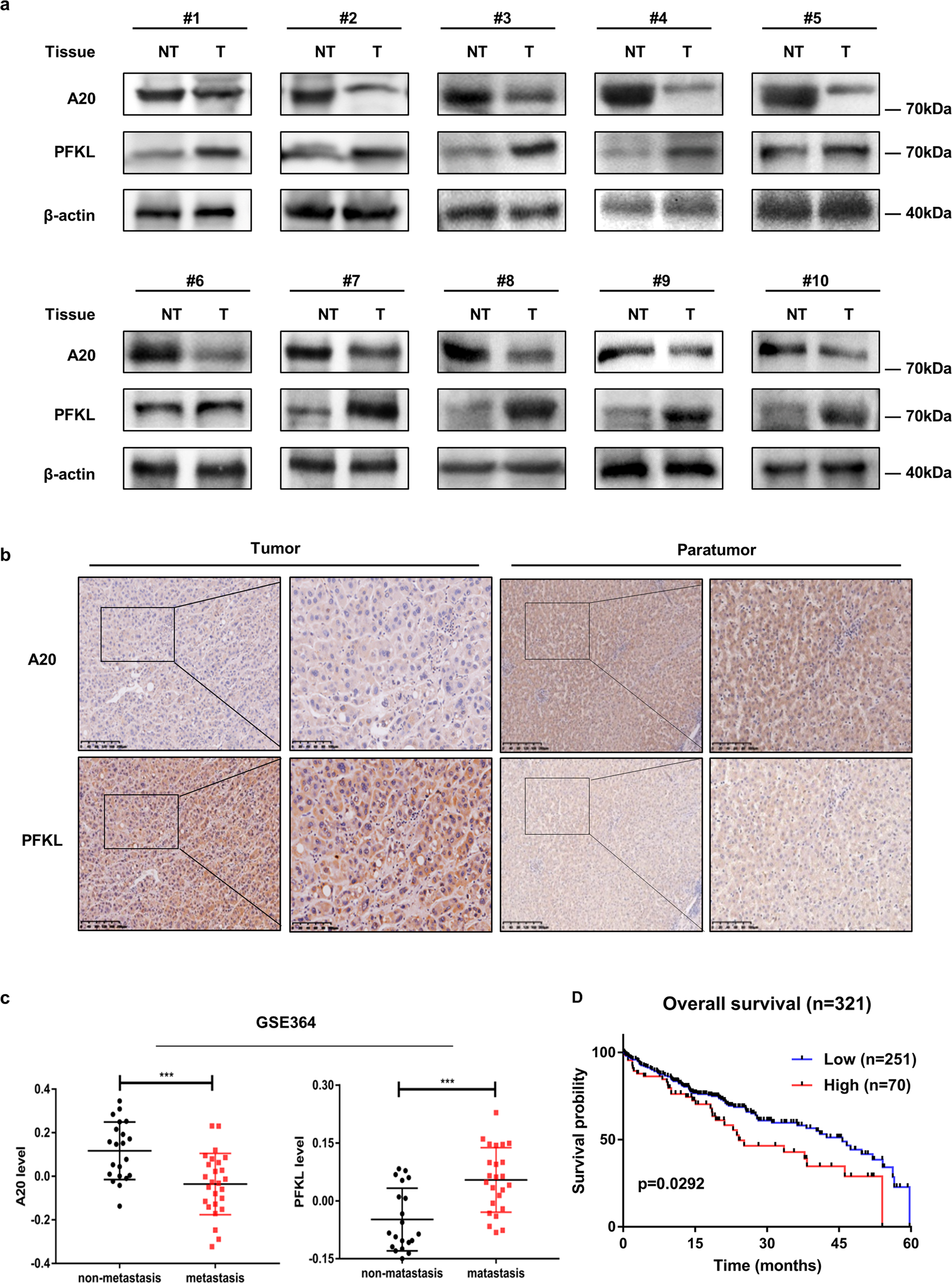 Fig. 6: A20 expression is inversely correlated with PFKL in HCC patients.