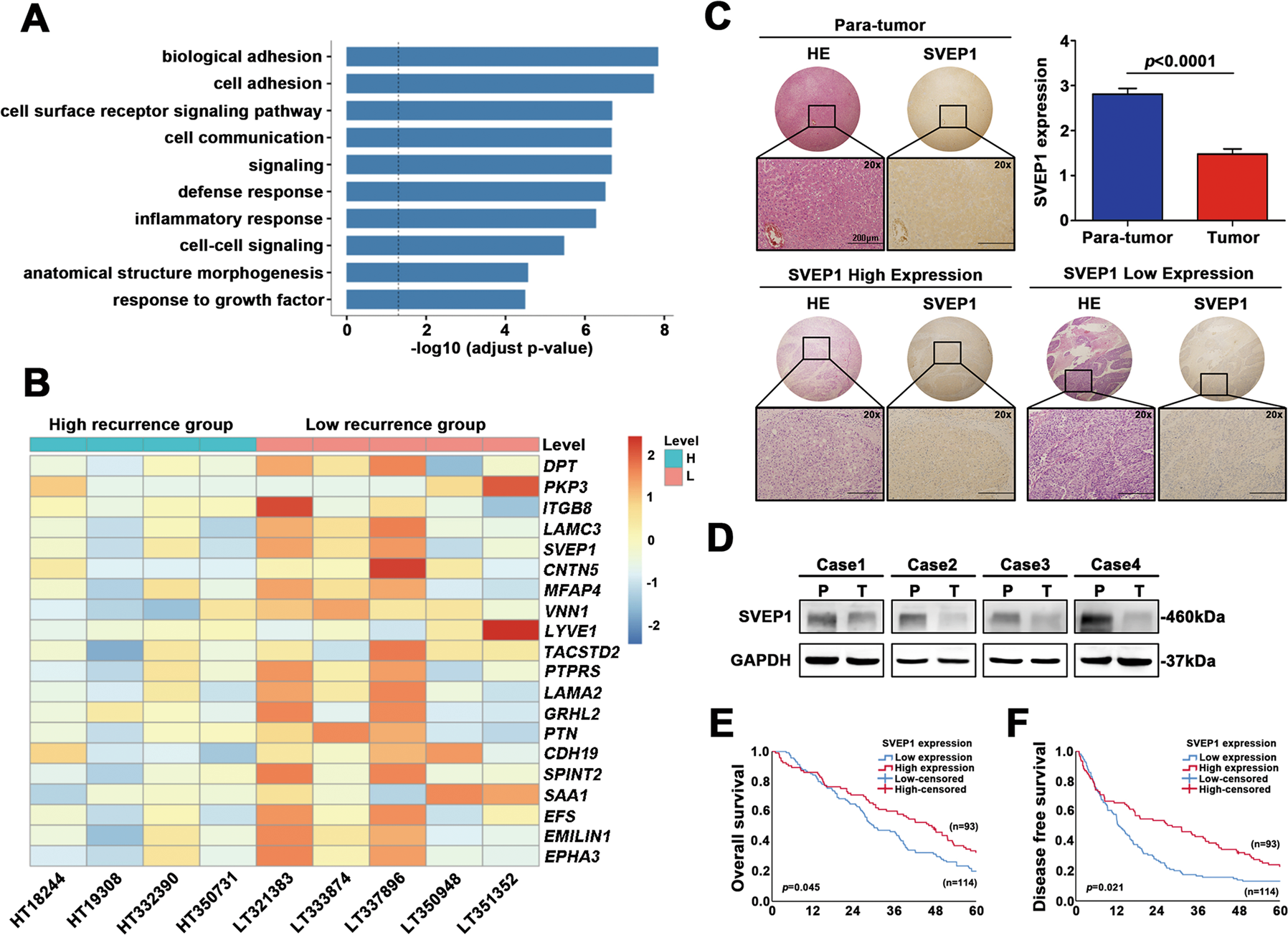 Fig. 1: SVEP1 expression pattern and its correlation with prognosis in human HCC.