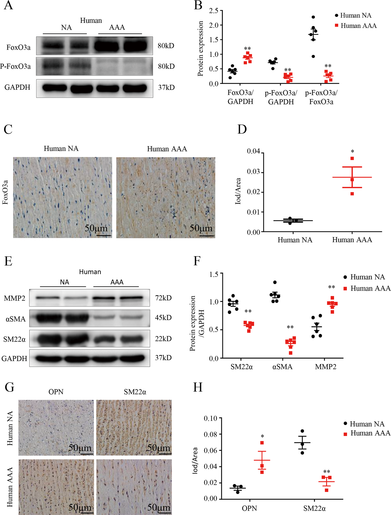 Fig. 1: FoxO3a is upregulated in human tissues and the VSMC phenotypic switch occurs during abdominal aortic aneurysm (AAA) formation.
