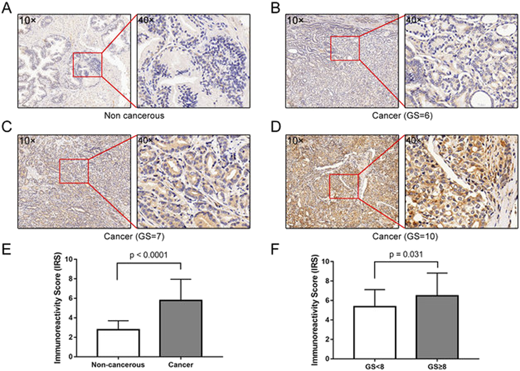 Fig. 1: Immunostaining of MAP1LC3B in PCa and normal prostate tissues.