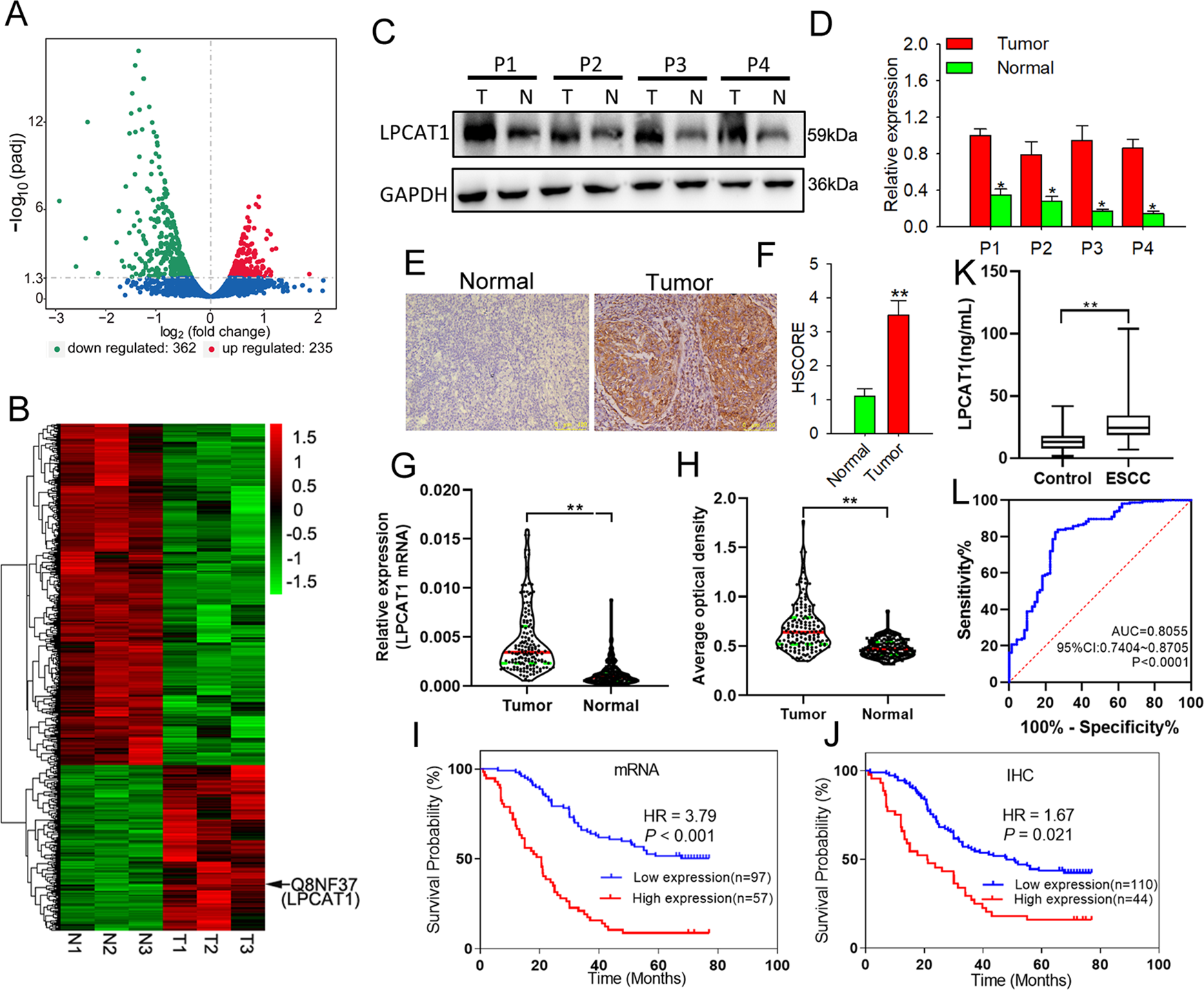 LPCAT1 reprogramming cholesterol metabolism promotes the progression of  esophageal squamous cell carcinoma | Cell Death & Disease