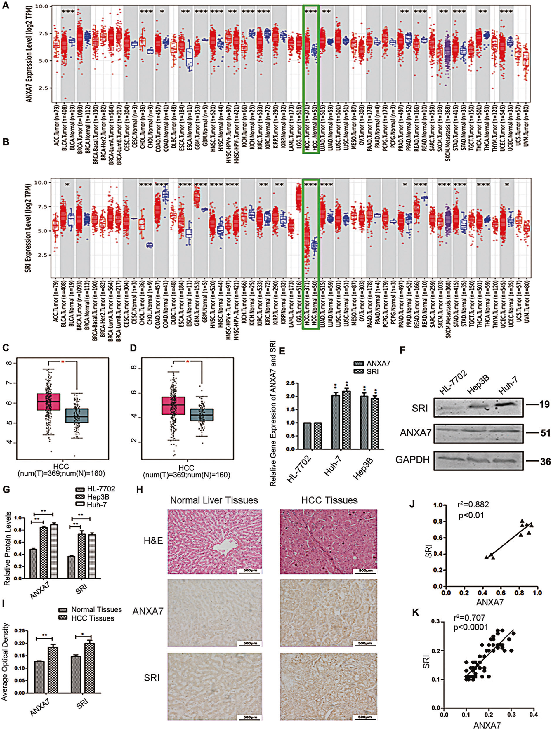 Fig. 1: The expression of ANXA7 and SRI and the positive correlation between them in HCC.