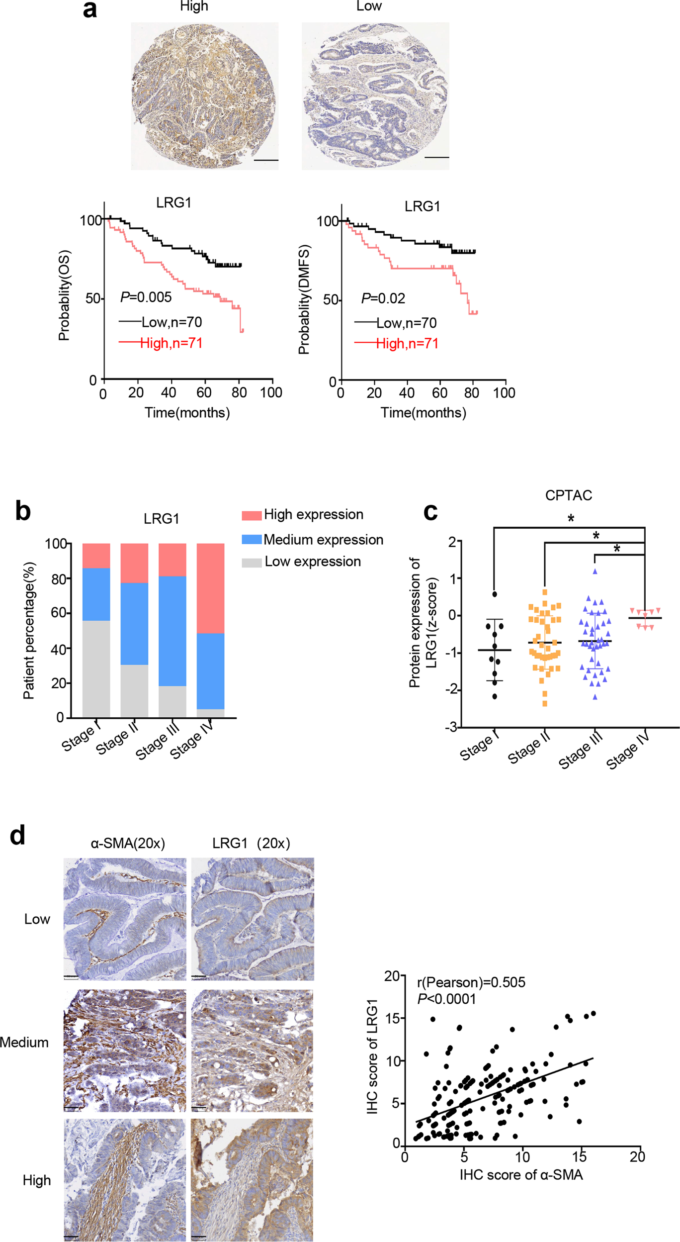 Fig. 6: CAFs-associated high expression of LRG1 predicts poor clinical outcome in CRC.