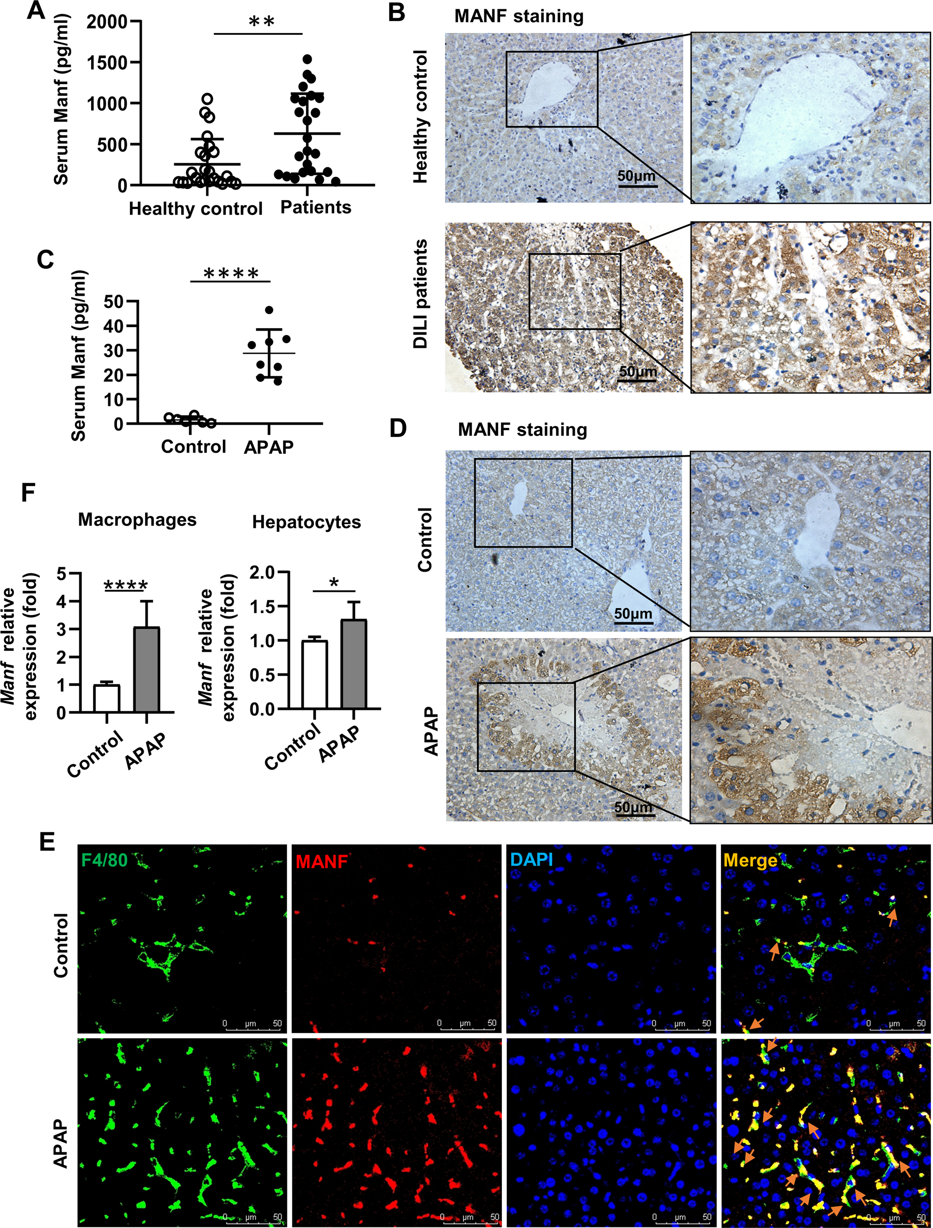 Fig. 1: Increased MANF expression in drug-induced liver injury (DILI) patients and an AILI mouse model.