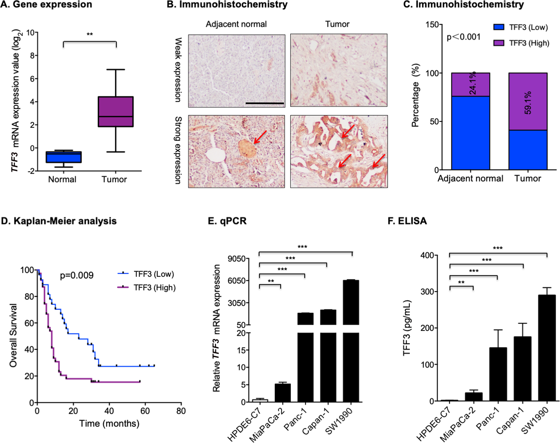 Fig. 1: TFF3 expression was increased in PDAC.