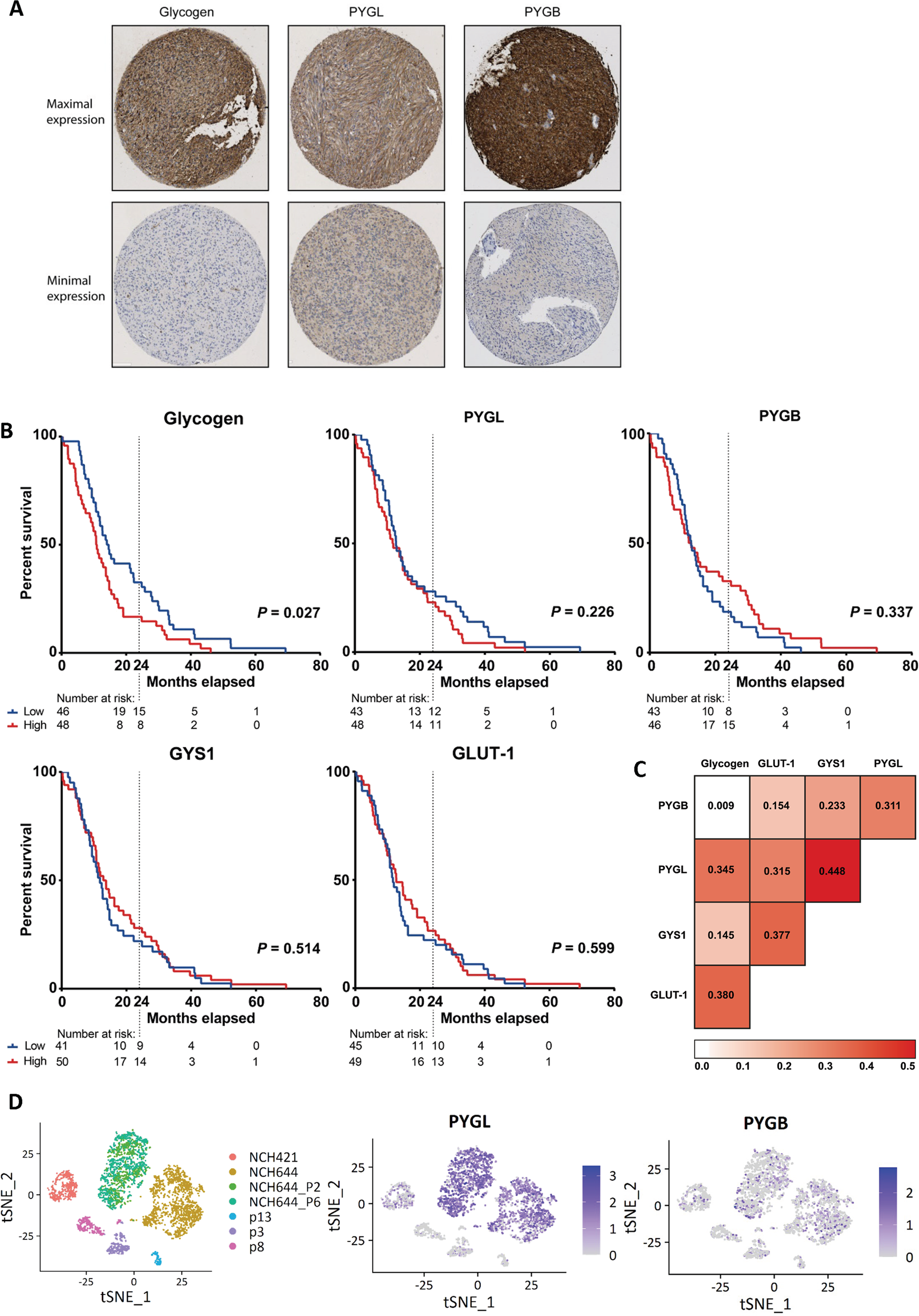 Fig. 6: Gene and protein expression of glycogen and glycogen related enzymes in glioblastoma (GBM) patient tumours.