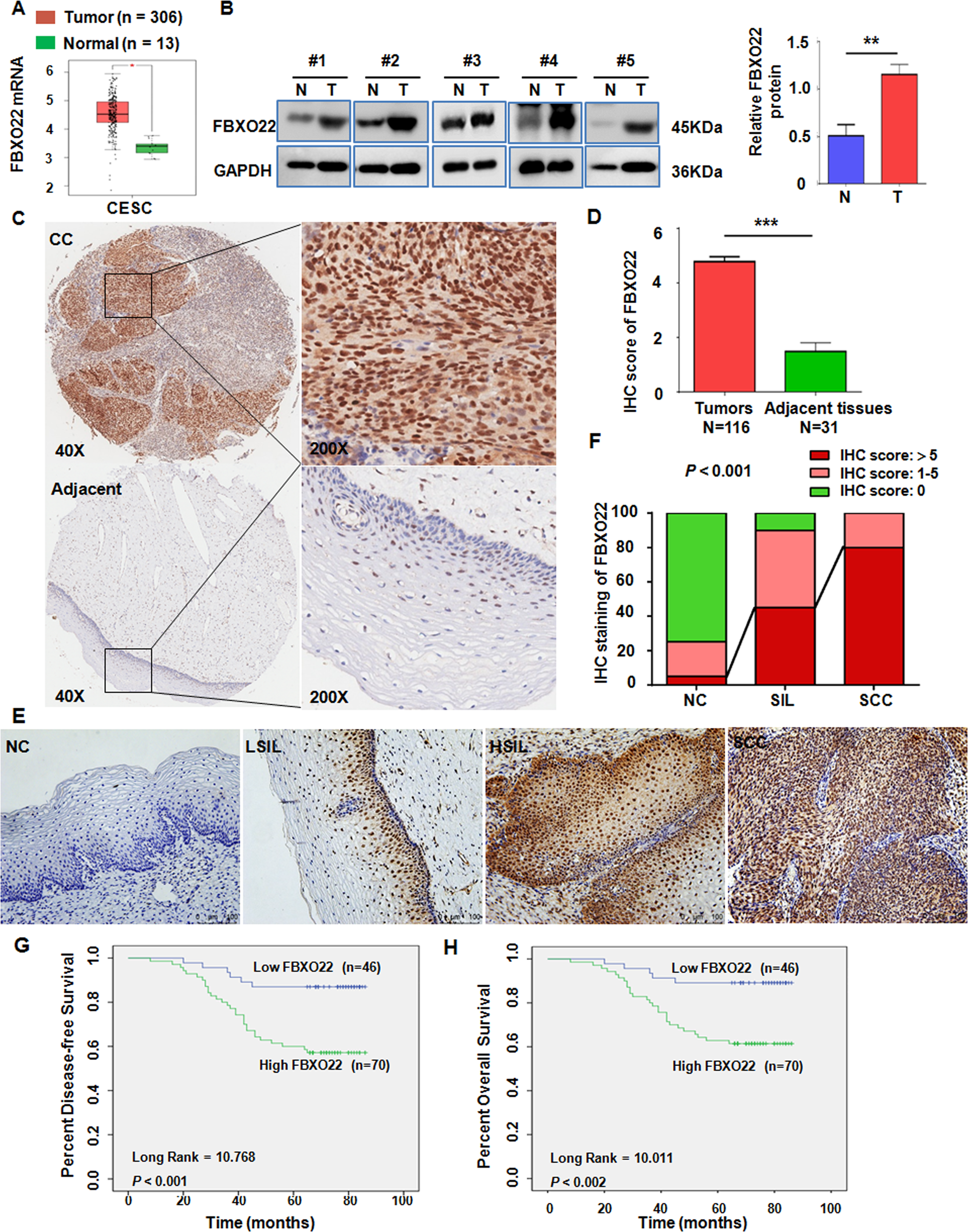 Fig. 1: FBXO22 expression is upregulated in cervical cancer and correlated with neoplastic progression and survival of CC patients.