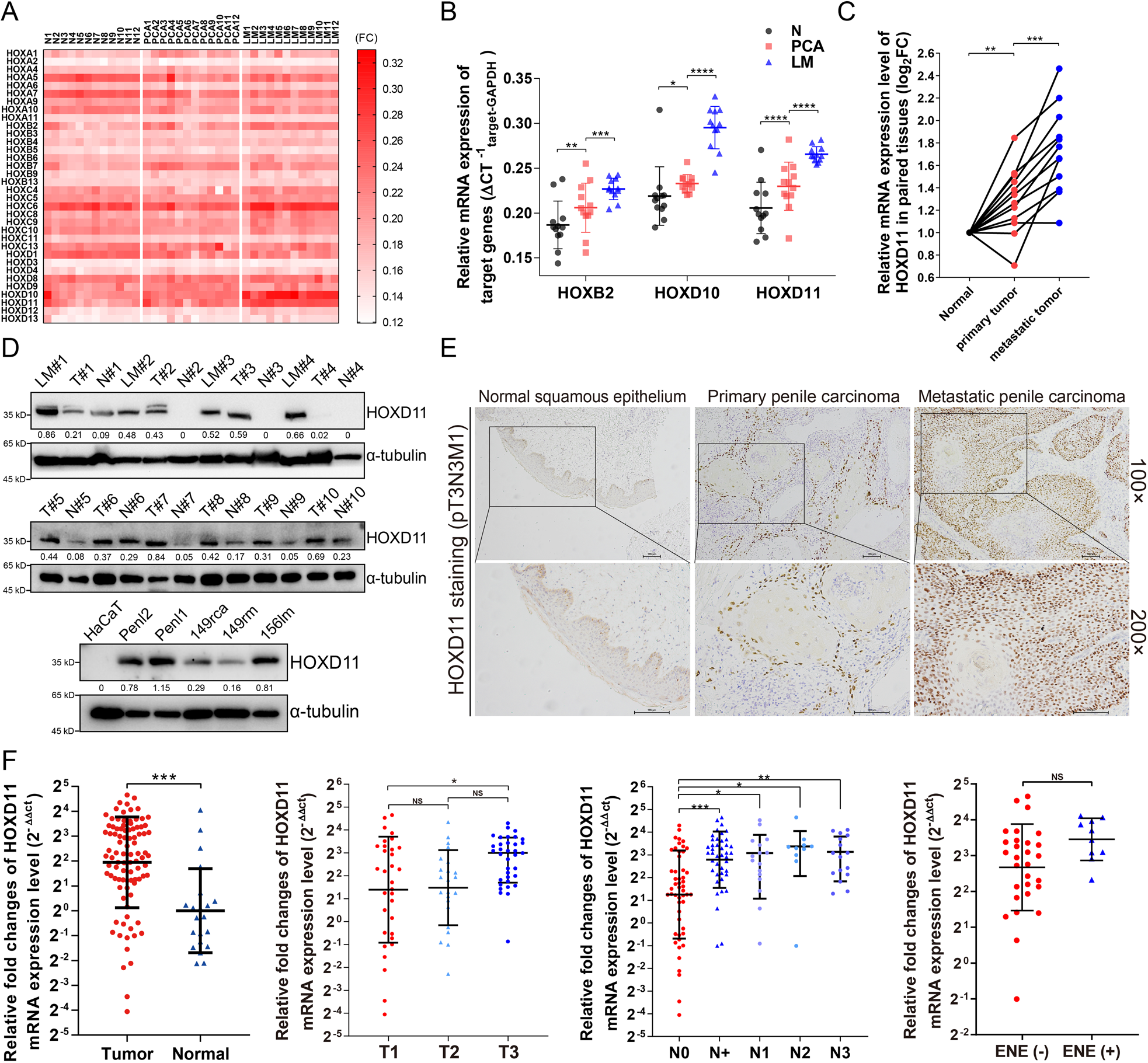 Fig. 1: HOX genes expression patterns and clinical significance of HOXD11 in PSCC.