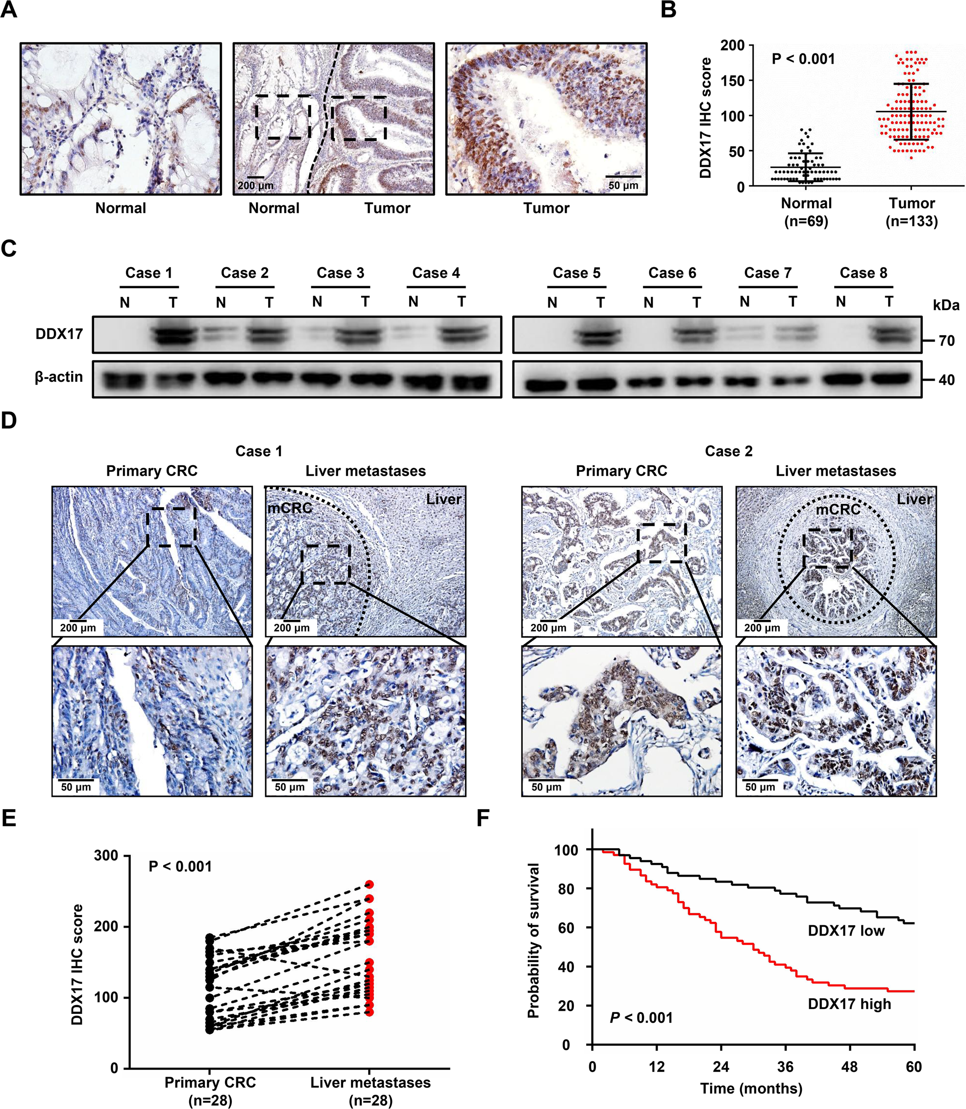 Fig. 1: DDX17 is upregulated in CRC and correlates with CRC liver metastasis.