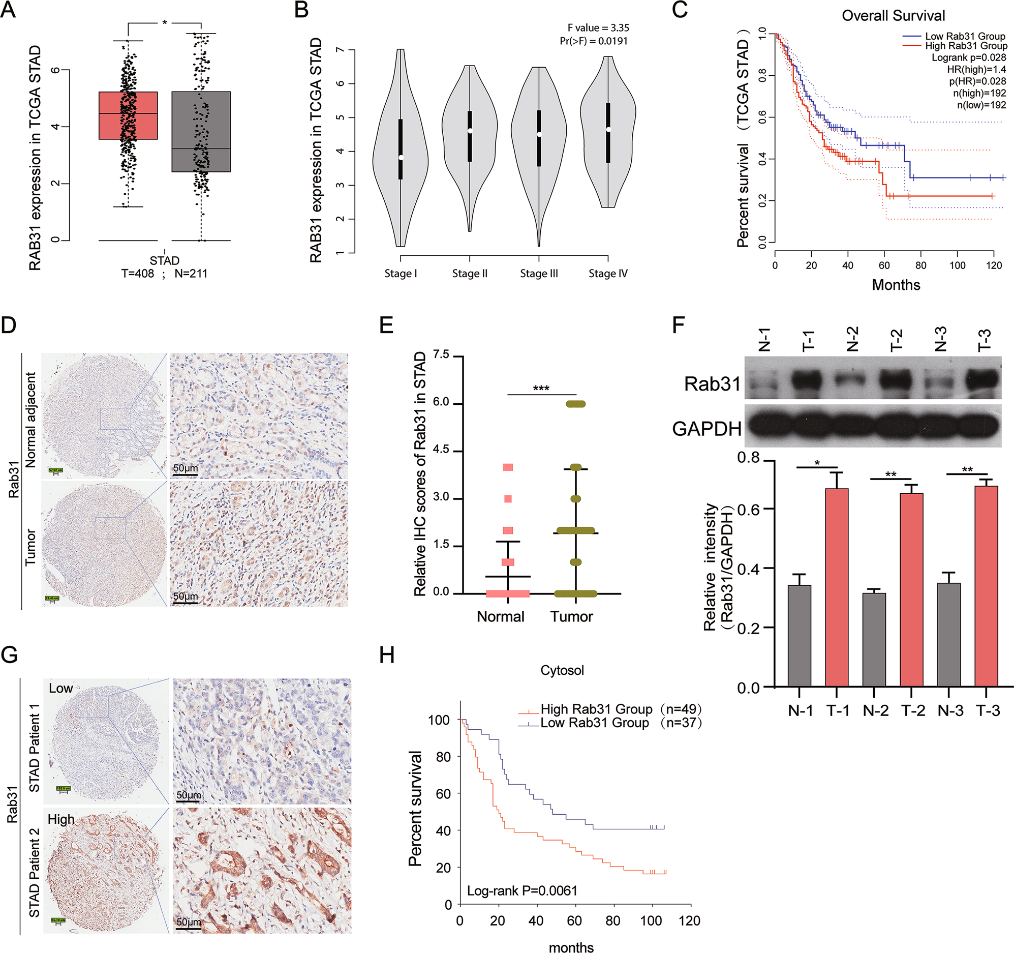 Fig. 1: High expression levels of Rab31 were observed in the STAD clinical samples and predicted poor prognosis.