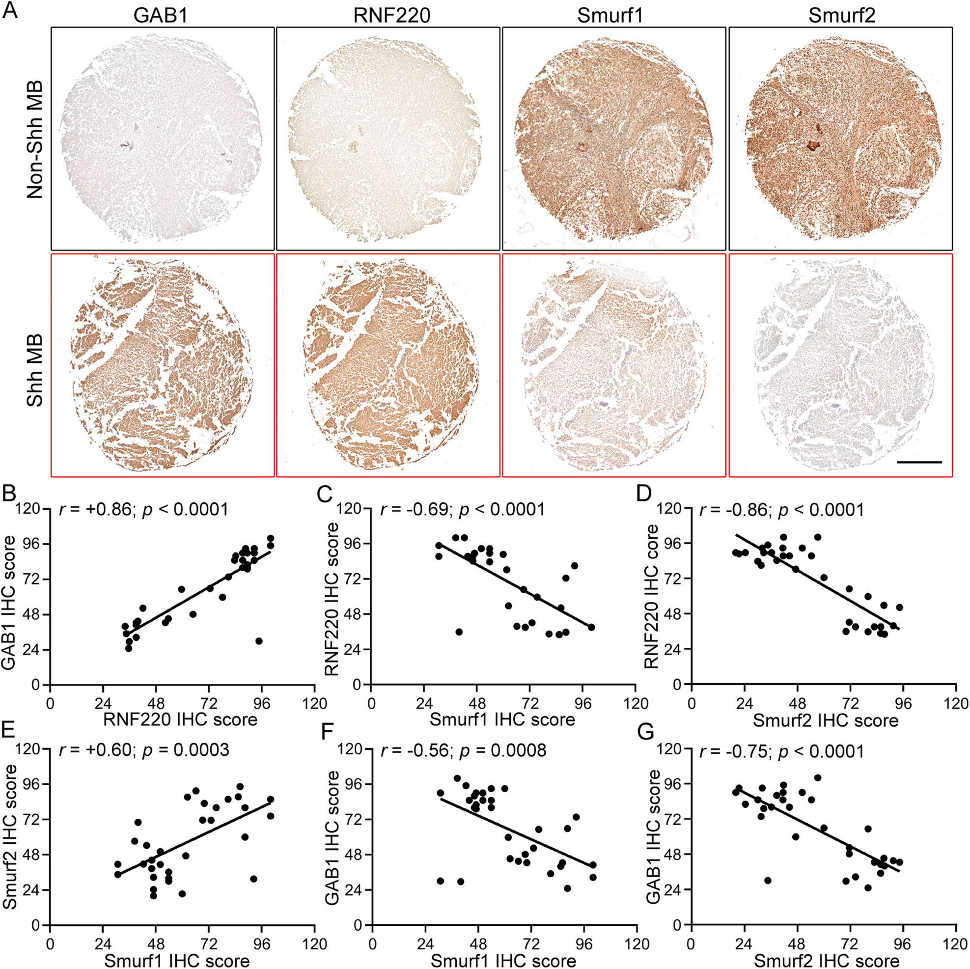 Fig. 7: Protein expression correlation analyzes among GAB1, RNF220, Smurf1, and Smurf2 in human clinical medulloblastoma samples.