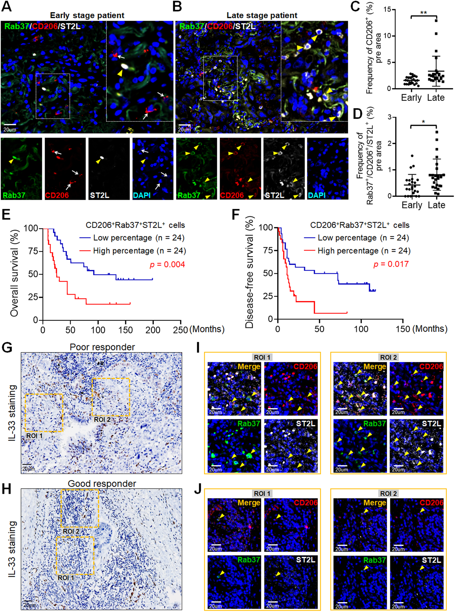 Fig. 6: Lung cancer patients with high Rab37+ST2L+CD206+ expression correlate with poor survival and treatment response.