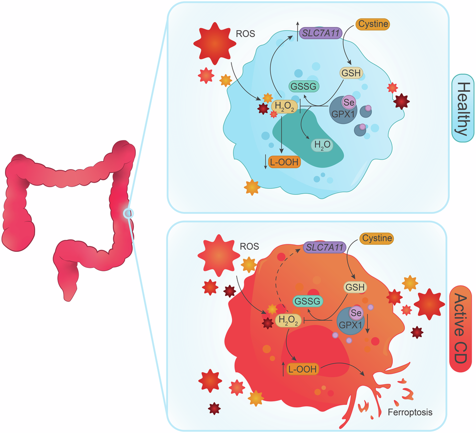 glutathione and crohns GPx1 deficiency confers increased susceptibility to ferroptosis in  macrophages from individuals with active Crohn's disease