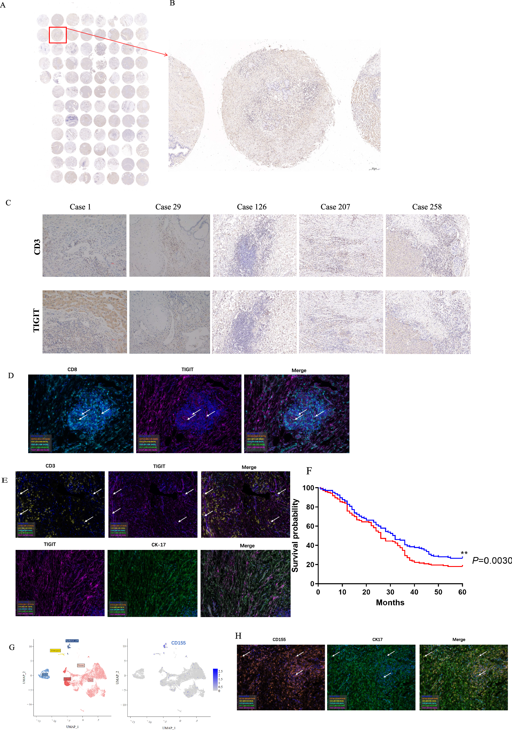 Fig. 3: Association of high TIGIT expression with reduced survival in ECCA patients.
