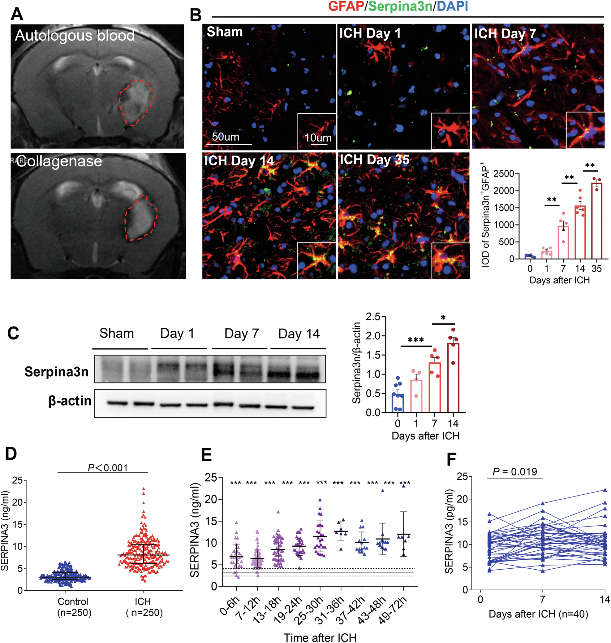 Fig. 2: The expression of Serpina3n/SERPINA3 in ICH mouse brain and blood from patients with ICH.
