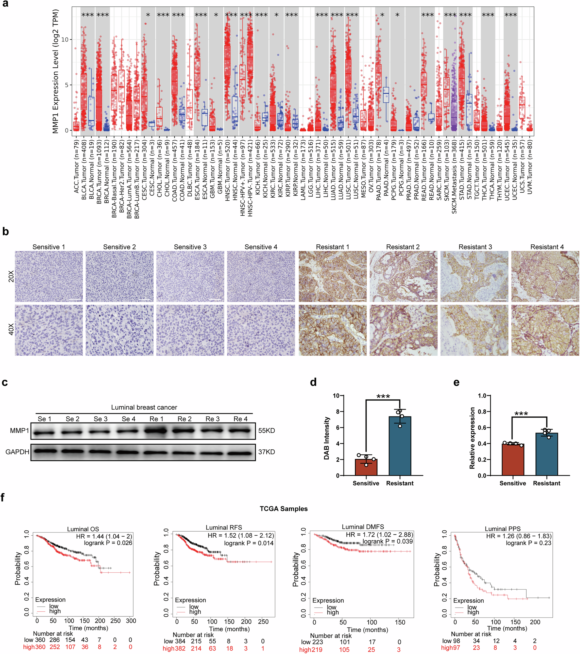 Fig. 2: High expression of MMP1 in HR + BC tissues and its association with poor prognosis.