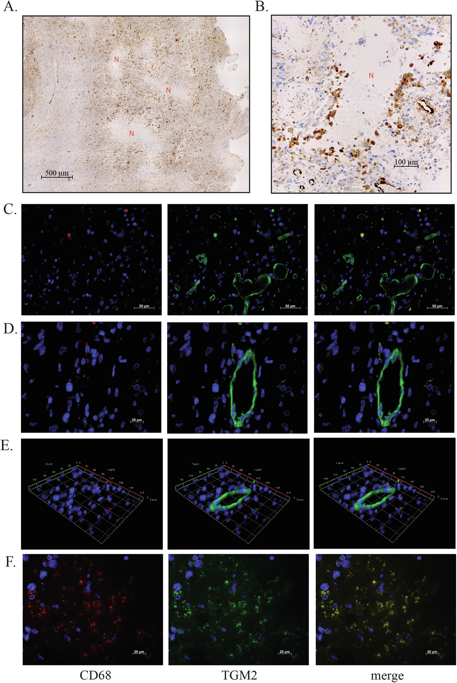 Fig. 4: TGM2 staining patterns in human glioblastoma tumours.