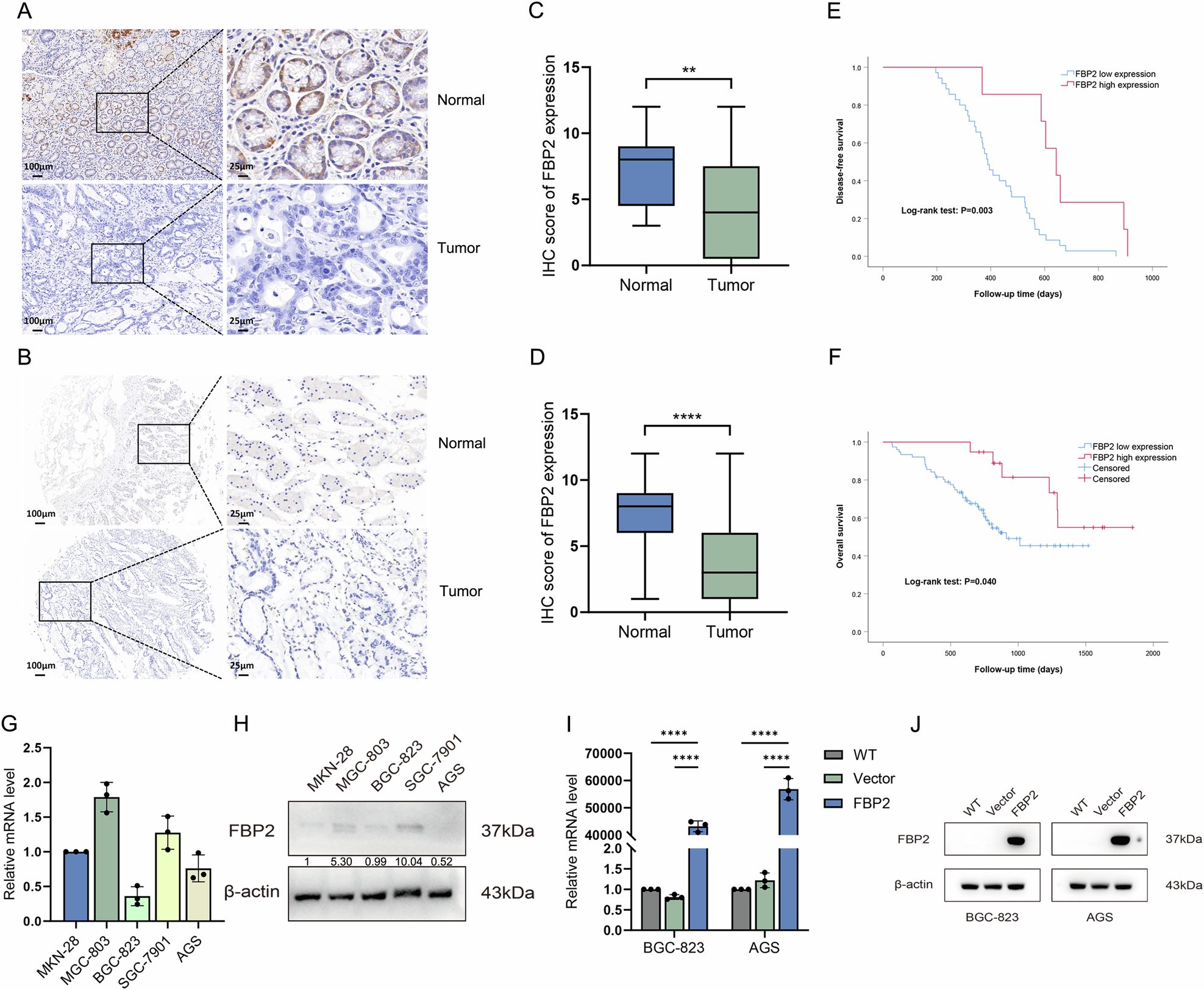 Fig. 2: The expression and clinical significance of FBP2 in GC tissues, as well as the establishment and validation of FBP2 overexpression in GC cell lines.