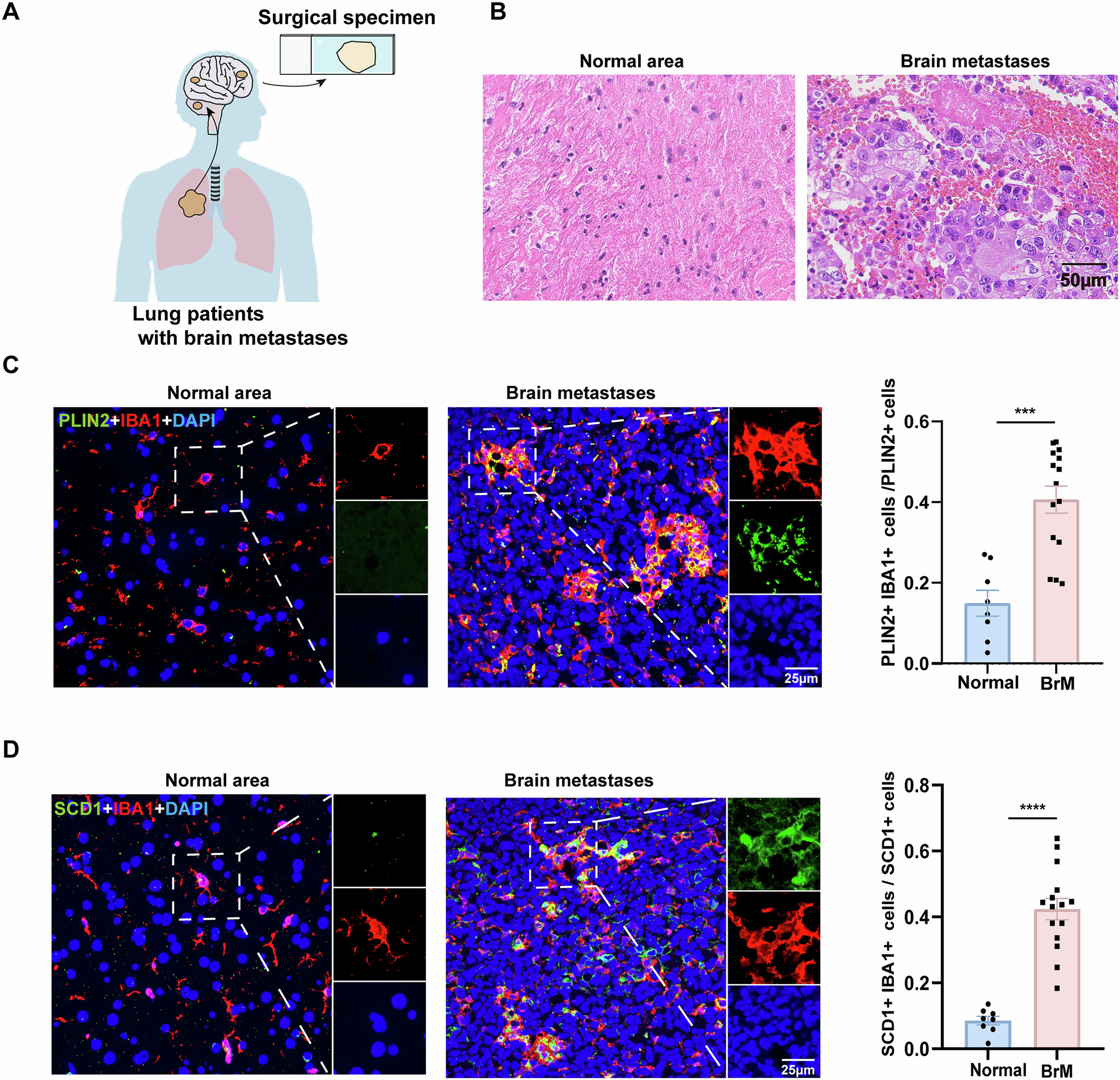 Fig. 1: The microglia in the brain metastatic regions of patients exhibit high expression of SCD1 and increased synthesis of lipid droplets.