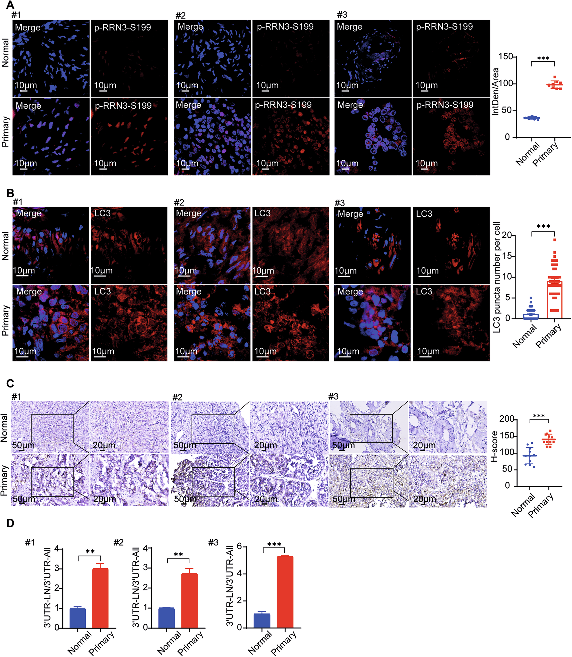 Fig. 8: Phosphorylation of RRN3 at serine 199 enhances autophagy contributing to ovarian cancer progression.