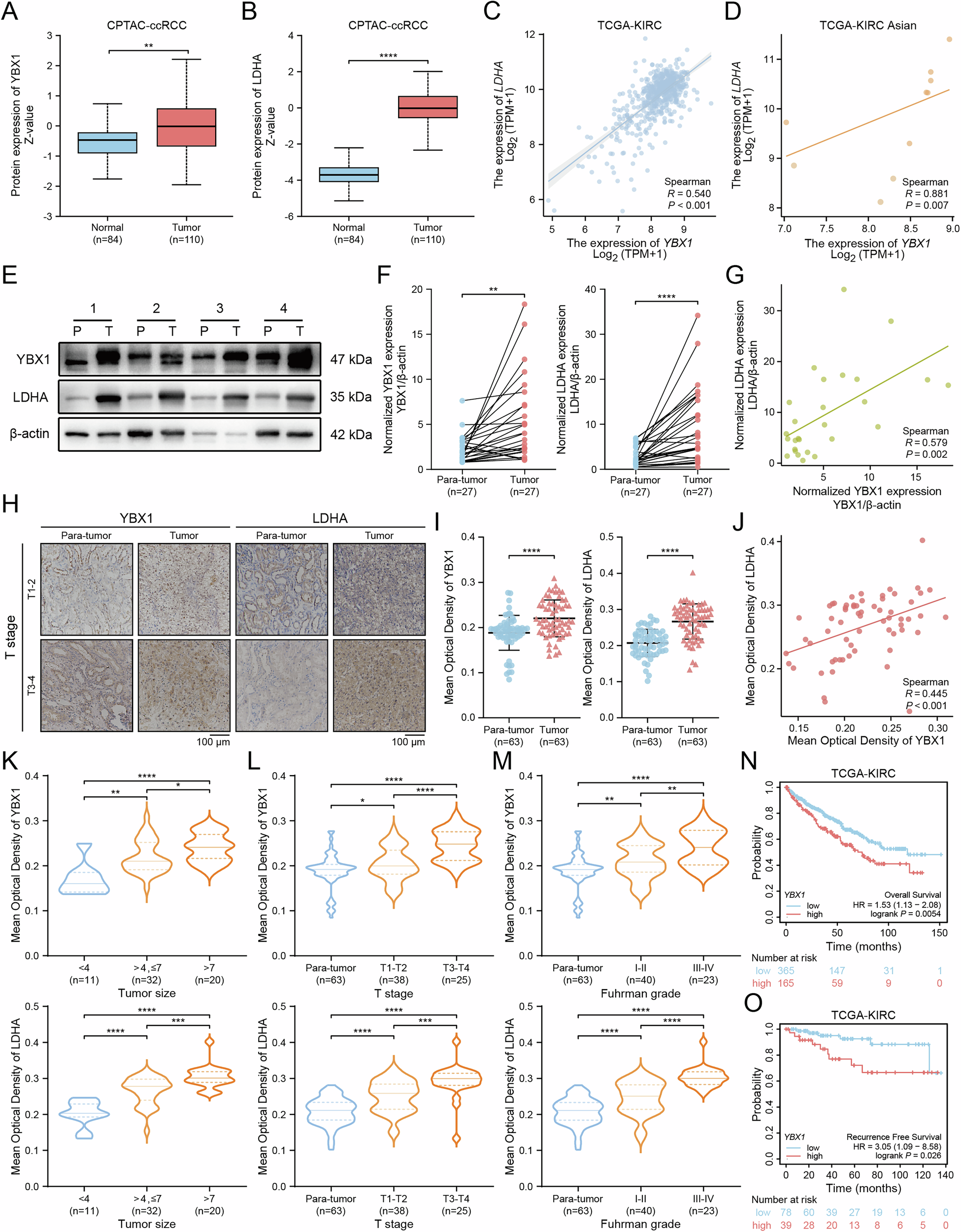 Fig. 4: YBX1 and LDHA proteins are highly expressed and correlate positively in ccRCC tissues.