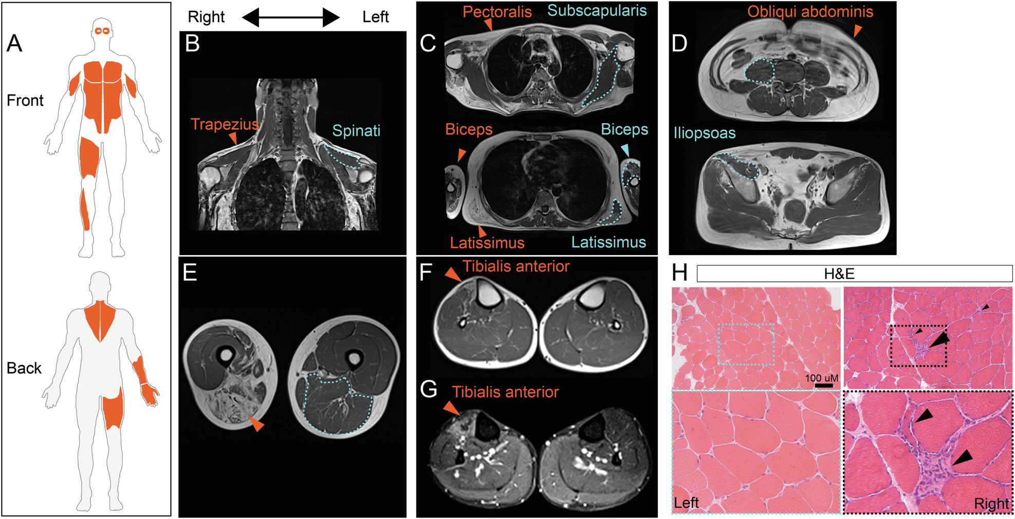 Fig. 1: Clinical presentation, muscle imaging and histopathology.
