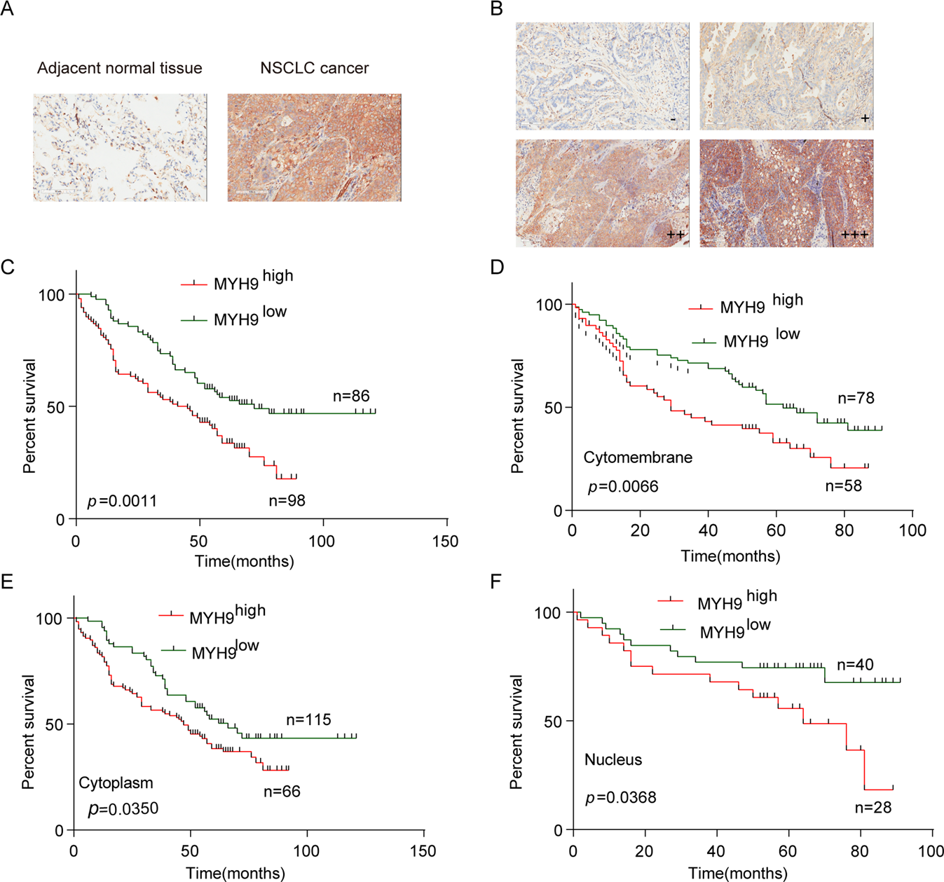 Fig. 6: MYH9 is an independent risk factor in patients with NSCLC.