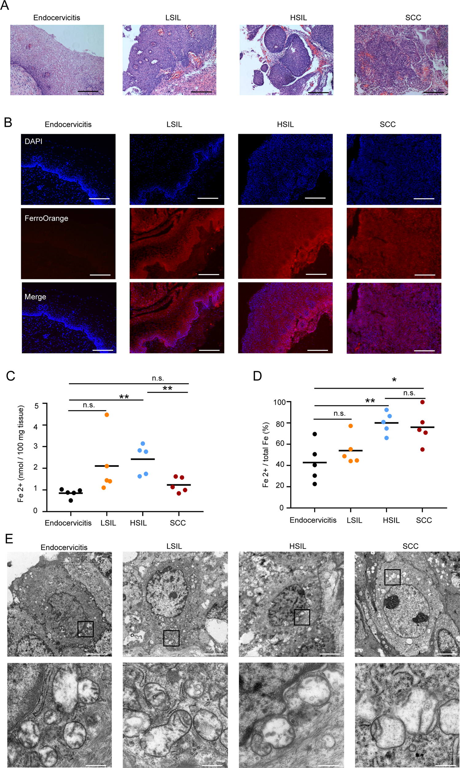 Fig. 6: High level of intercellular iron and abnormal mitochondria morphology present in cervical SIL progression.