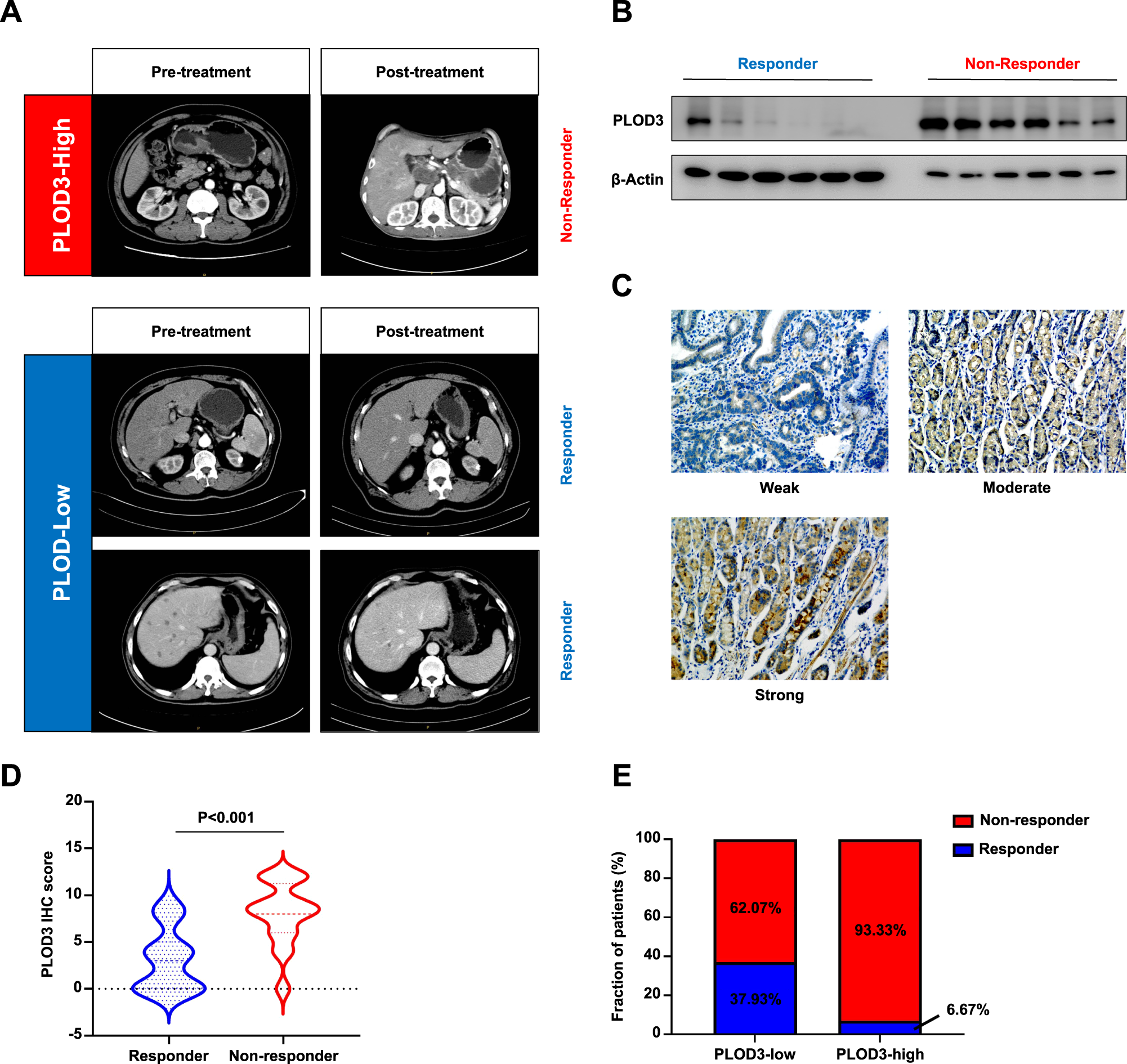 Fig. 3: The expression of PLOD3 is associated with Trastuzumab effectiveness in HER-2 positive GC patients.
