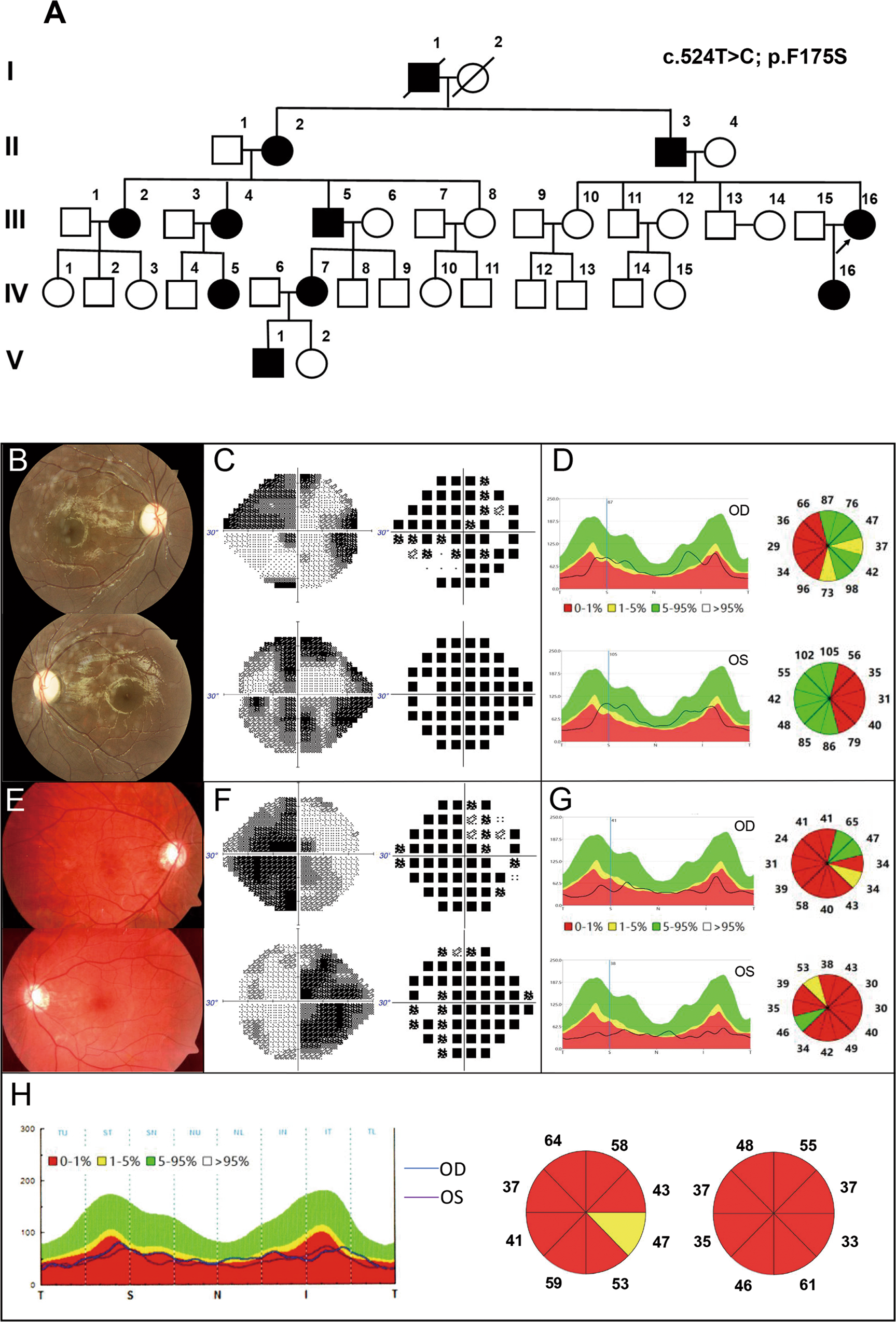 A novel mutation located in the intermembrane space domain of AFG3L2 causes  dominant optic atrophy through decreasing the stability of the encoded  protein | Cell Death Discovery
