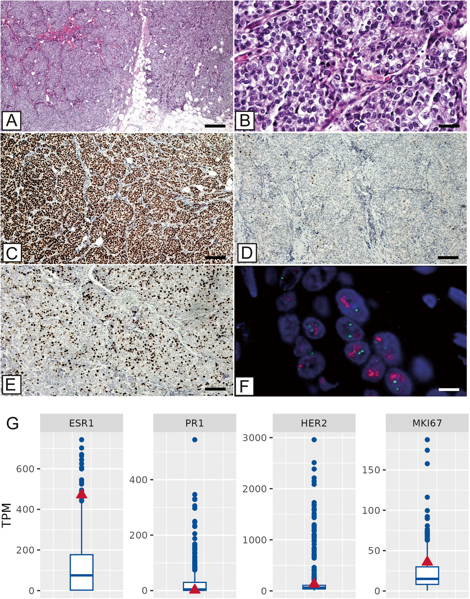 Fig. 1: Histopathological and molecular characterization of the tumor.