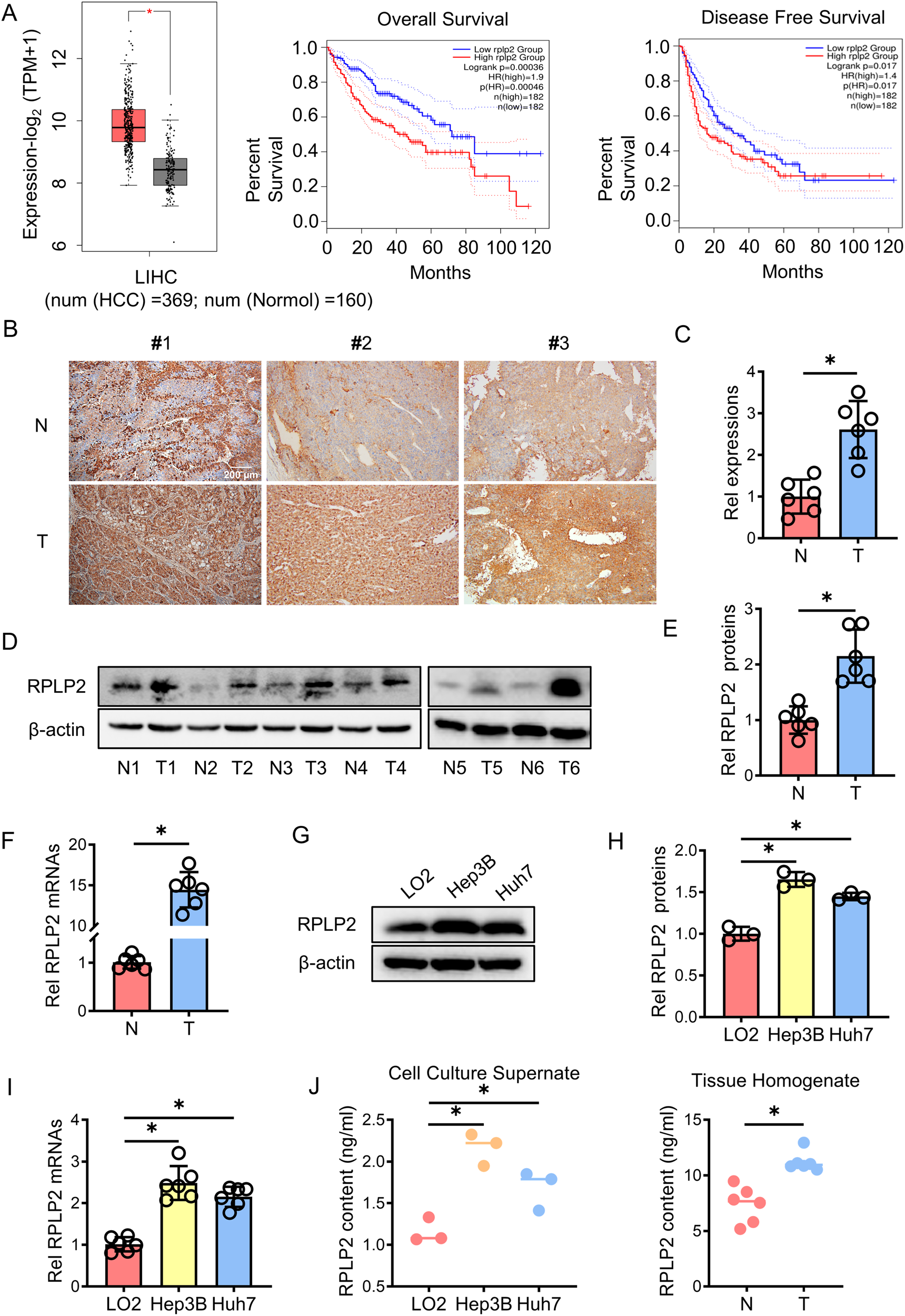 Fig. 1: RPLP2 was overexpressed in the tissues of patients with HCC.