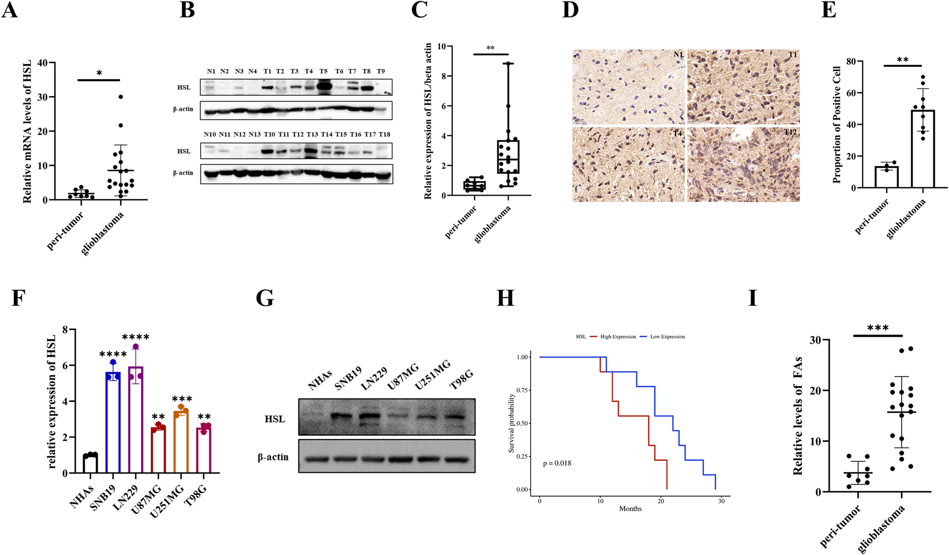 Fig. 1: High expression of HSL in glioblastoma.