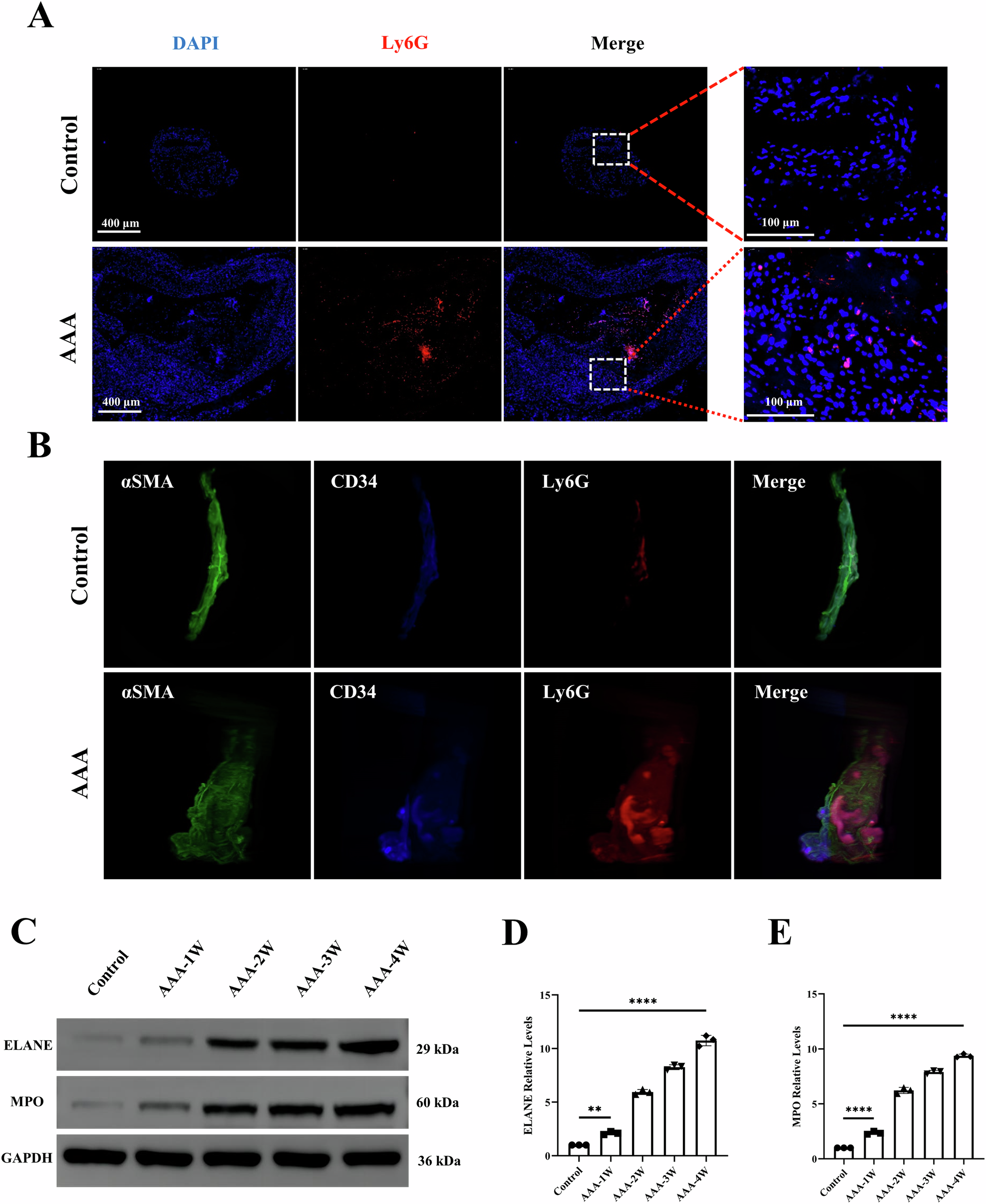 Fig. 2: Neutrophil infiltration and NETs release within AAA lesions.
