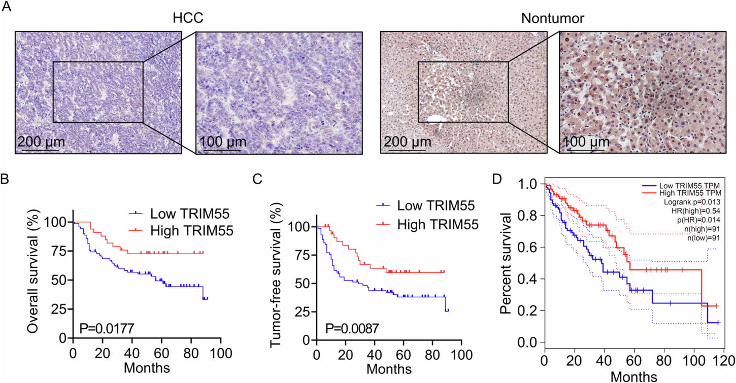 Fig. 1: Downregulation of TRIM55 predicts poor clinical outcome in patients with HCC.