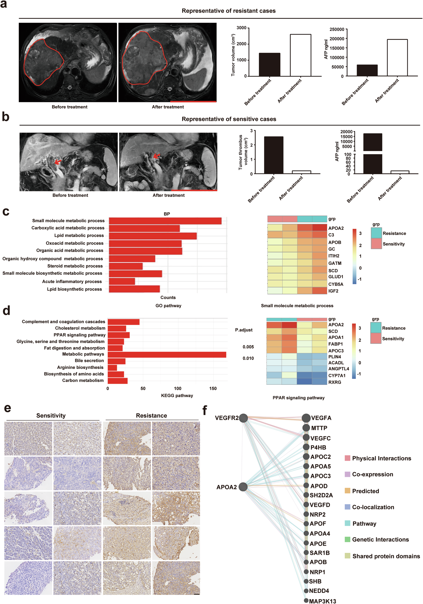 Fig. 1: High expression of APOA2 is highly correlated with resistance to AAD therapy in HCC.