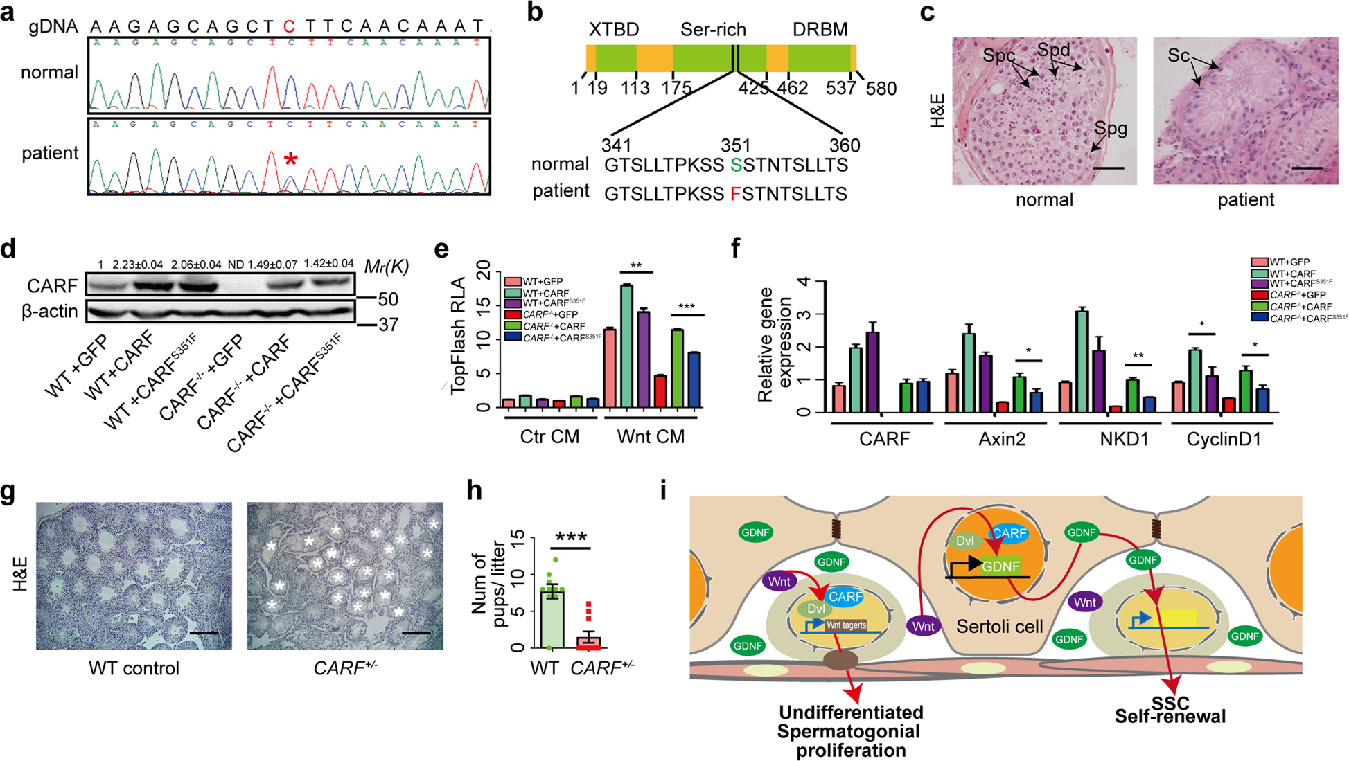 Fig. 7: Identification of a CARFS351Fmutation in SCO patients.