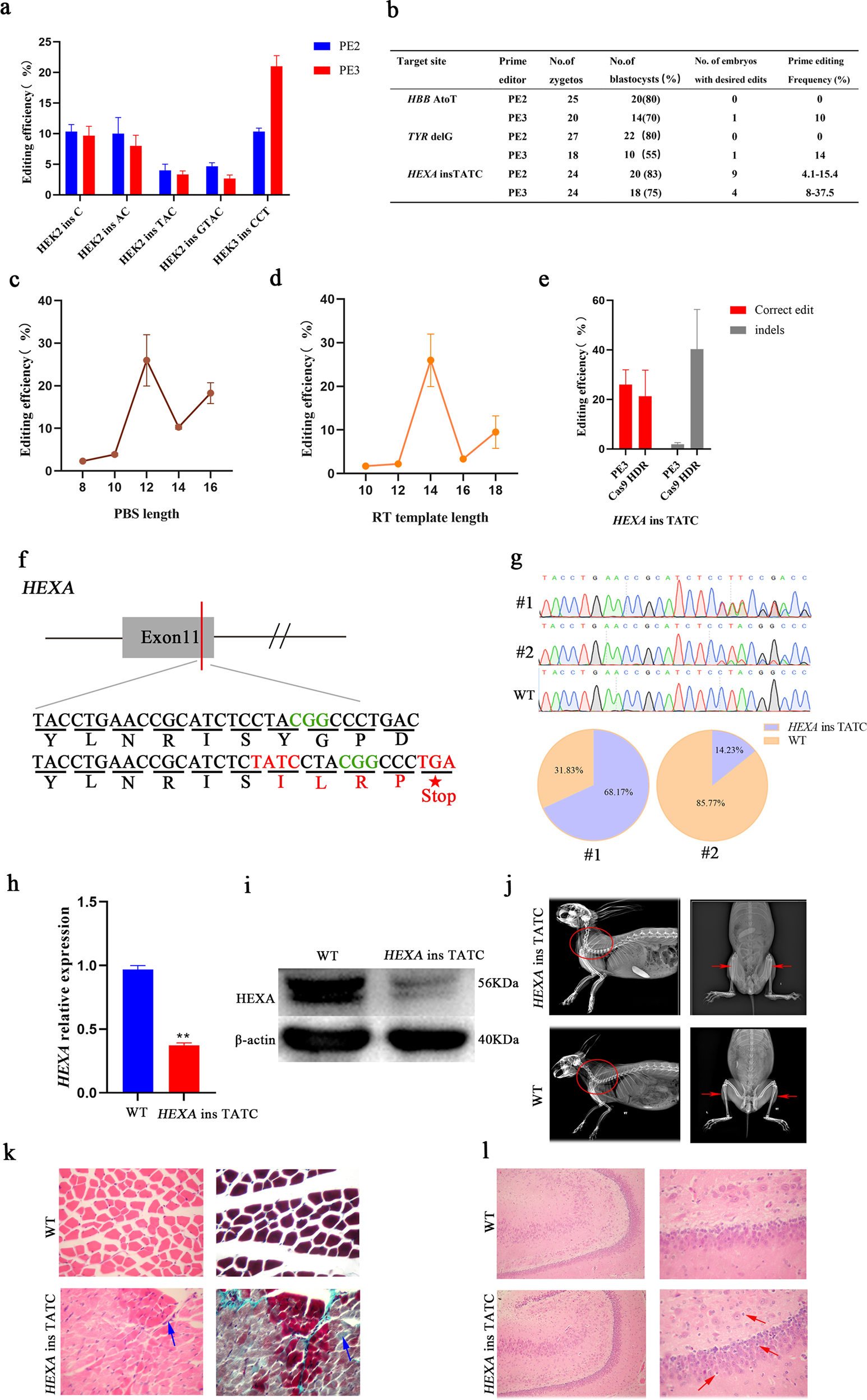 Strategies to combat Tay-Sachs disease - ScienceDirect