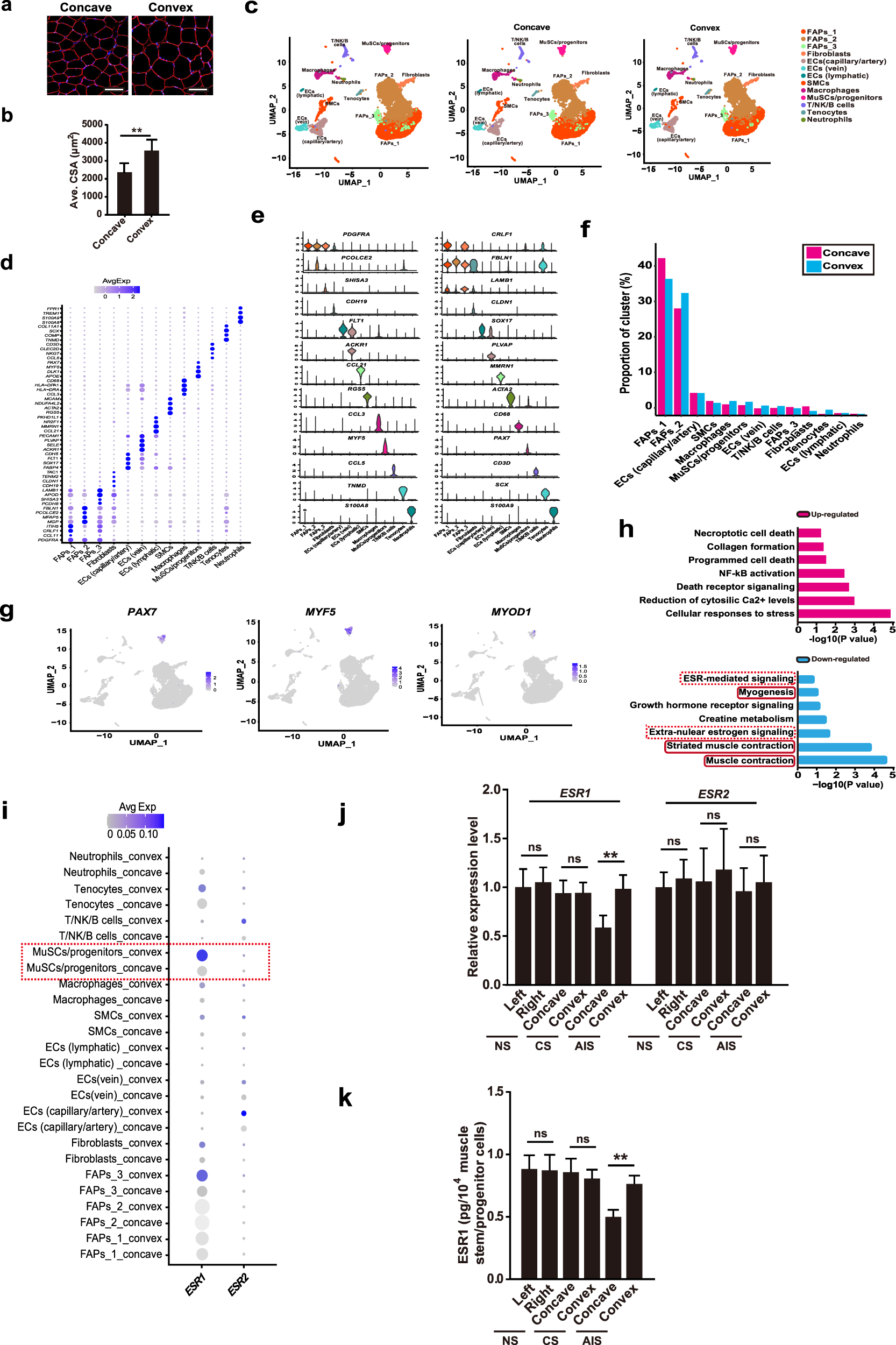 Fig. 1: ESR1 expression decreases in muscle stem/progenitor cells at the concave side of AIS patients.