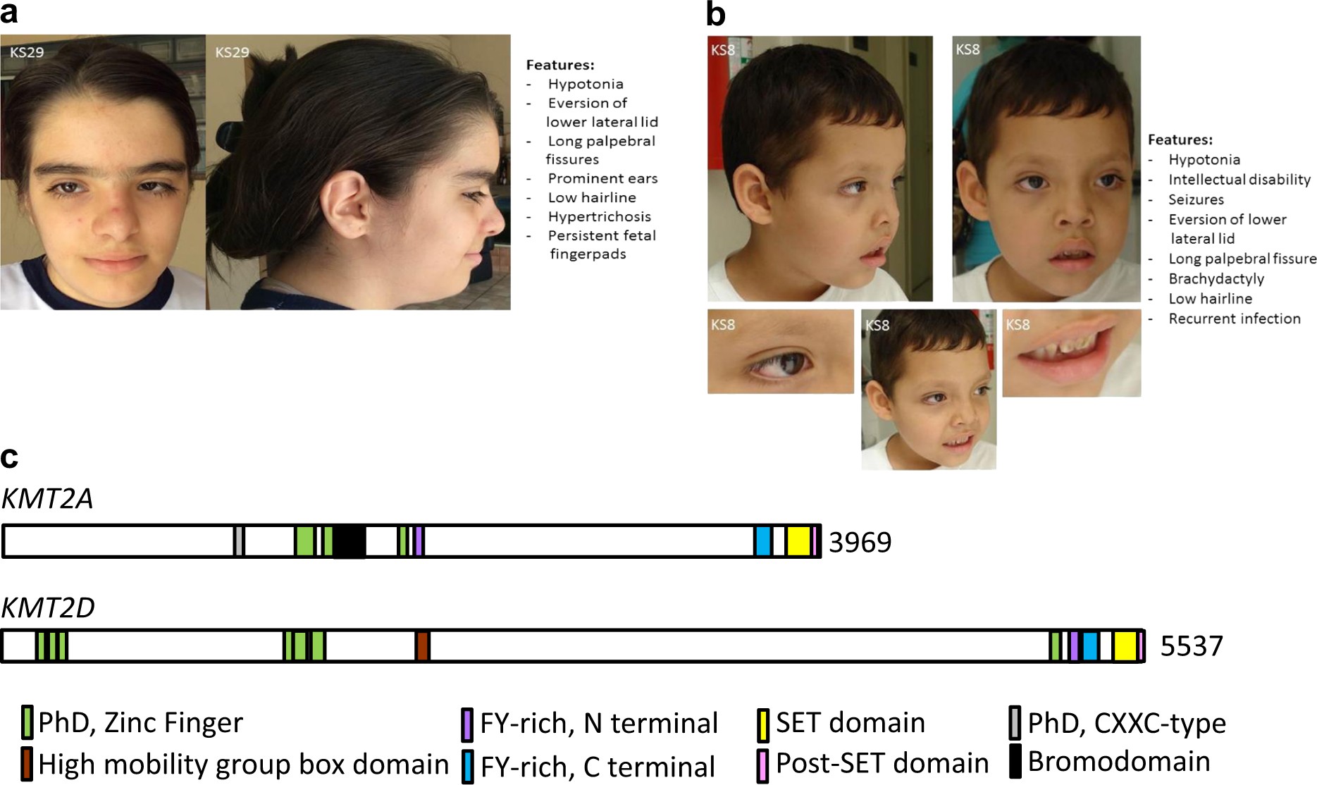 Expanding the phenotype associated to KMT2A variants: overlapping clinical  signs between Wiedemann–Steiner and Rubinstein–Taybi syndromes