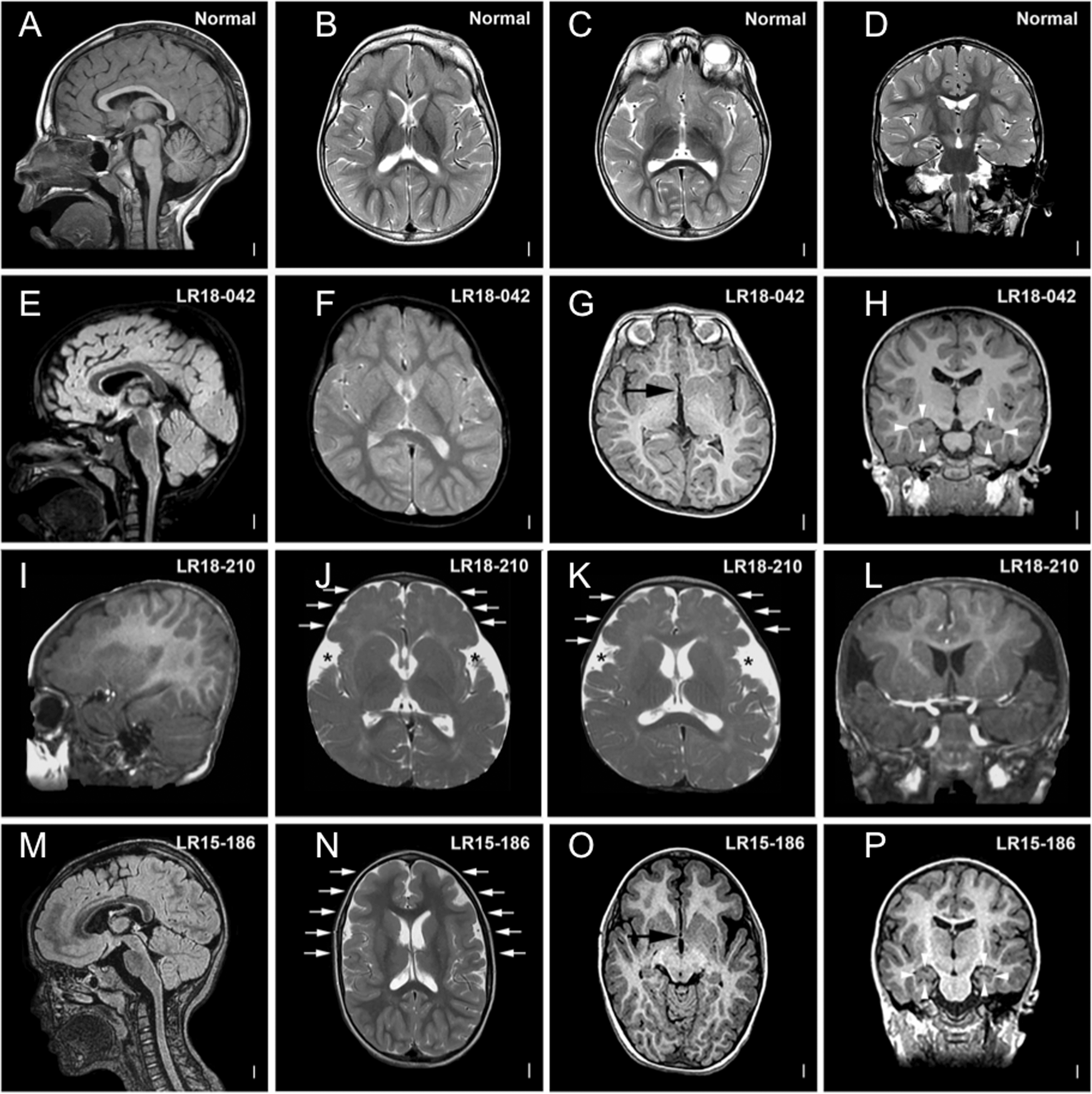 De novo TBR1 variants cause a neurocognitive phenotype with ID and autistic  traits: report of 25 new individuals and review of the literature |  European Journal of Human Genetics