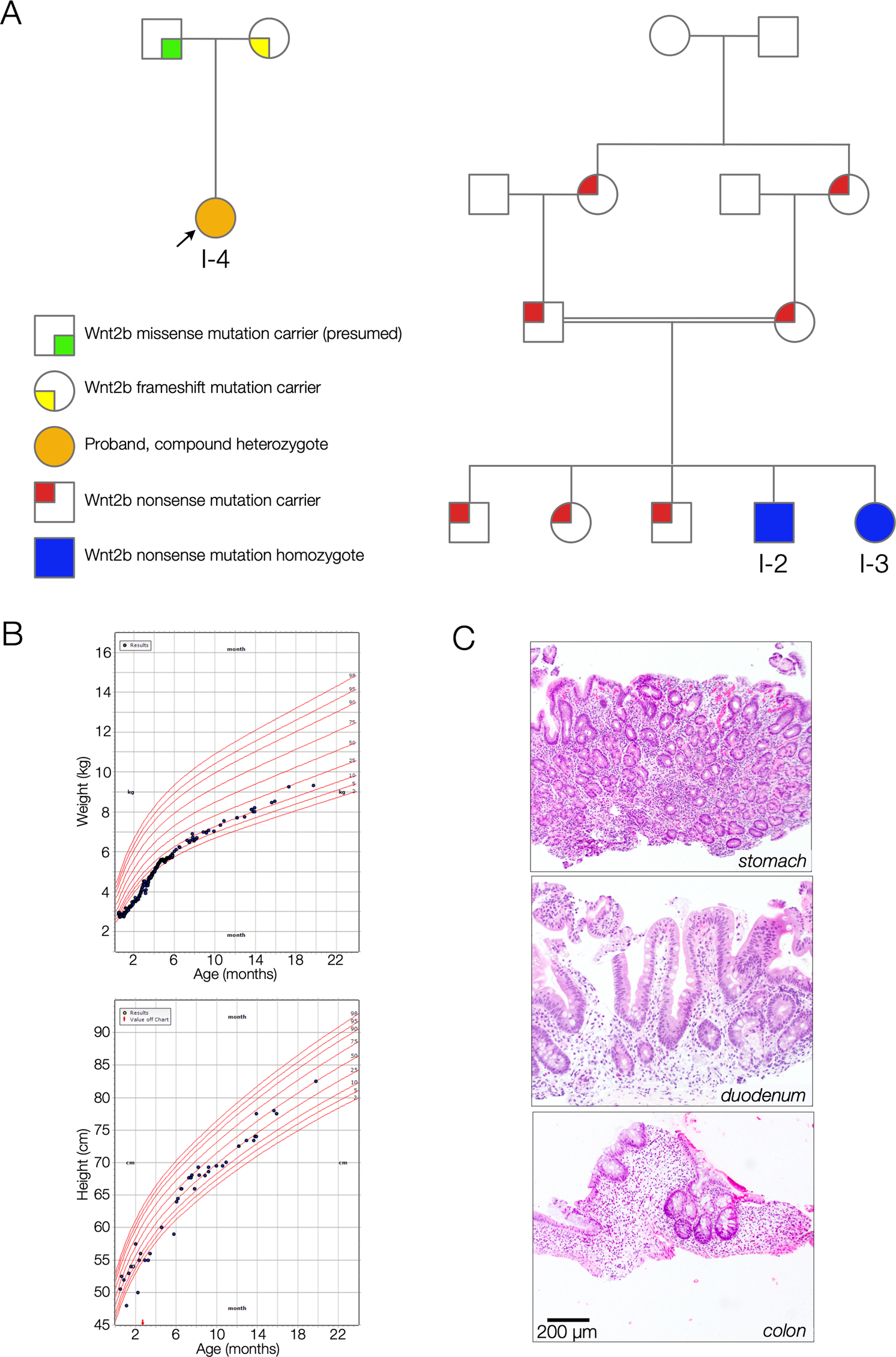 Novel Variants In The Stem Cell Niche Factor Wnt2b Define The Disease Phenotype As A Congenital Enteropathy With Ocular Dysgenesis European Journal Of Human Genetics Novel Variants In The Stem Cell Niche Factor Wnt2b Define The Disease Phenotype As A Congenital Enteropathy With Ocular Dysgenesis European Journal Of Human Genetics