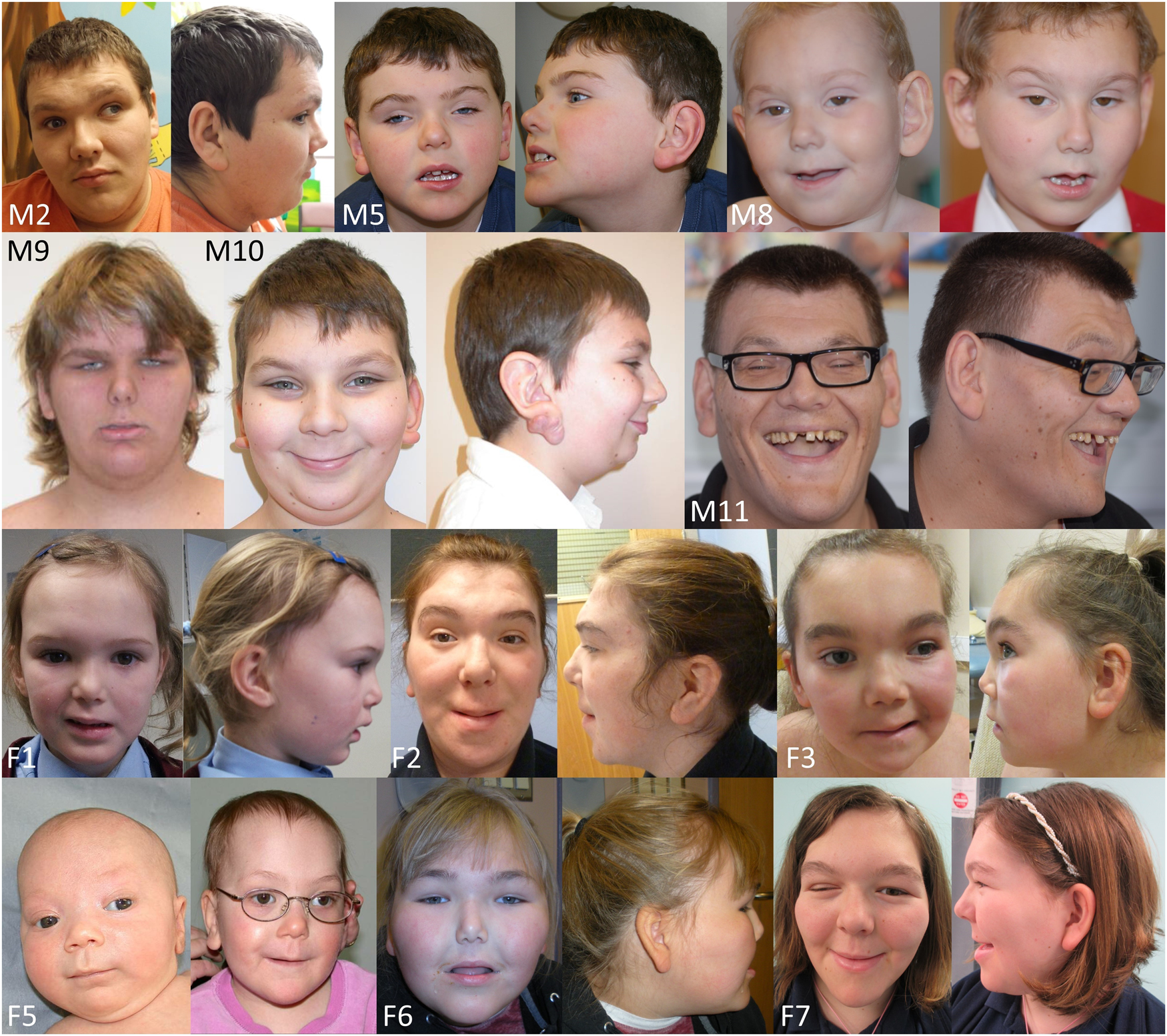 Börjeson–Forssman–Lehmann syndrome: delineating the clinical and allelic  spectrum in 14 new families | European Journal of Human Genetics