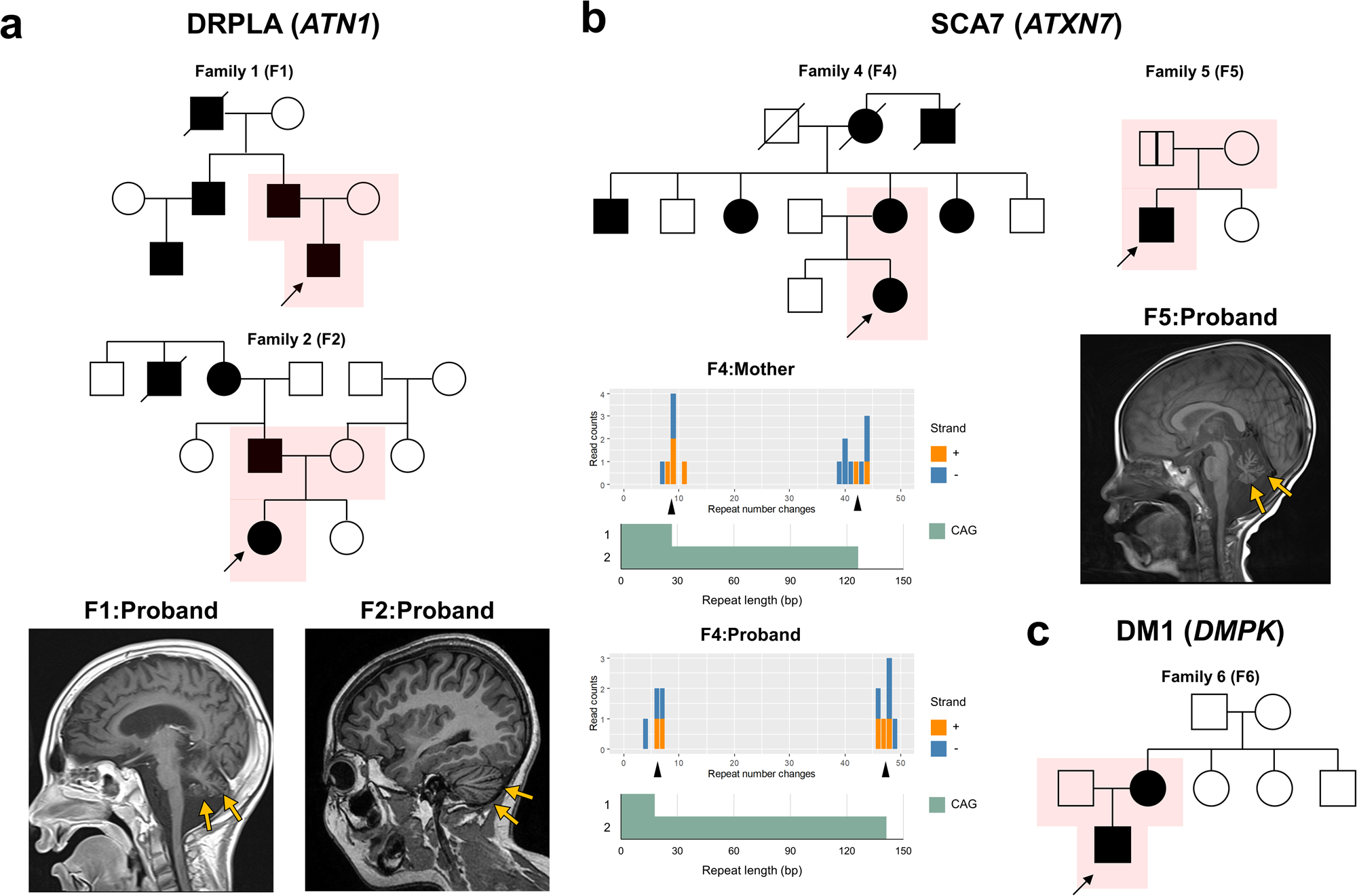 Fig. 1: Pedigree and brain imaging findings in representative cases identified by short tandem repeat (STR) analysis.