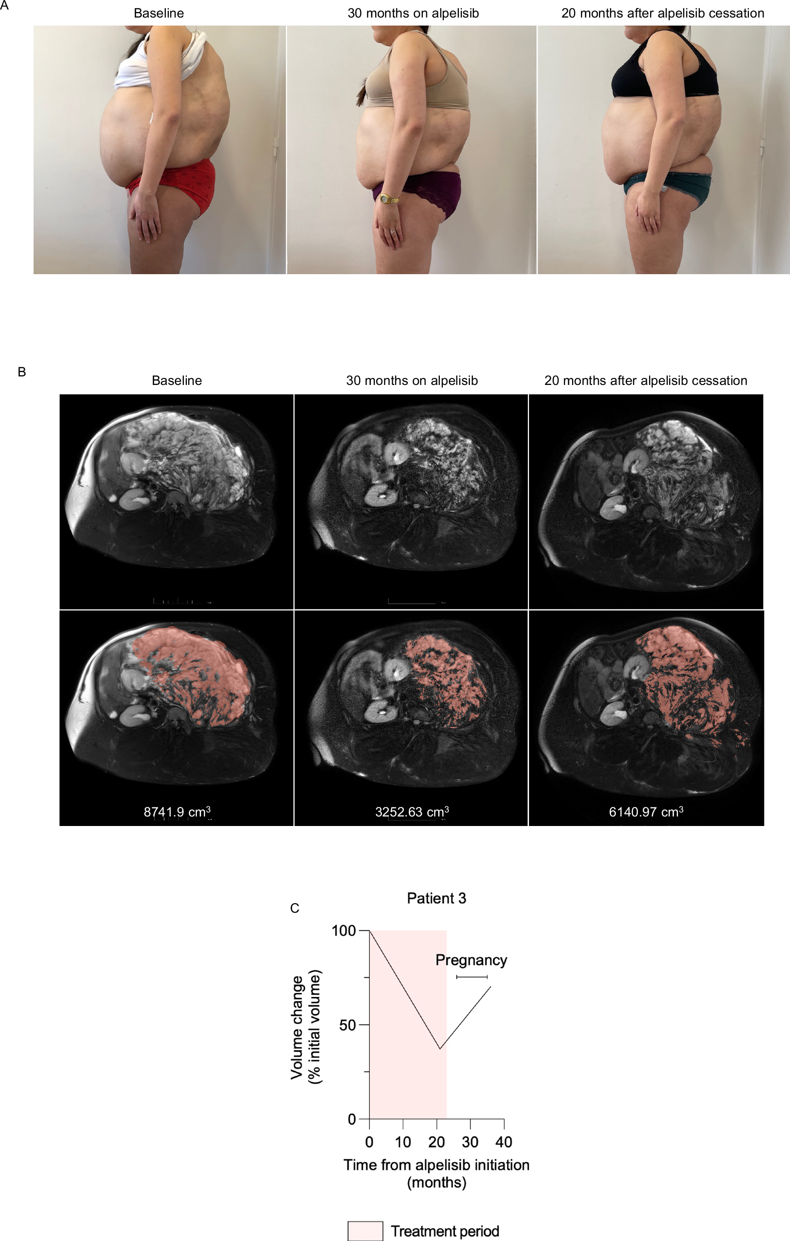 Fig. 3: Patient 3 following alpelisib withdrawal and reintroduction.